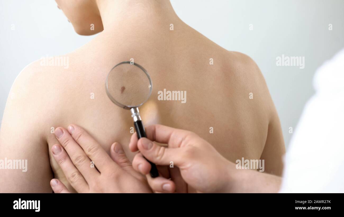 Dermatologist checking mole through magnifying glass, skin cancer prevention Stock Photo