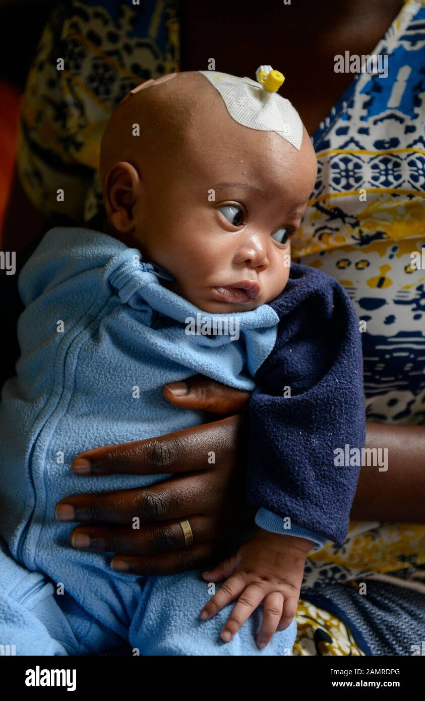 Hydrocephalus child hi-res stock photography and images - Alamy
