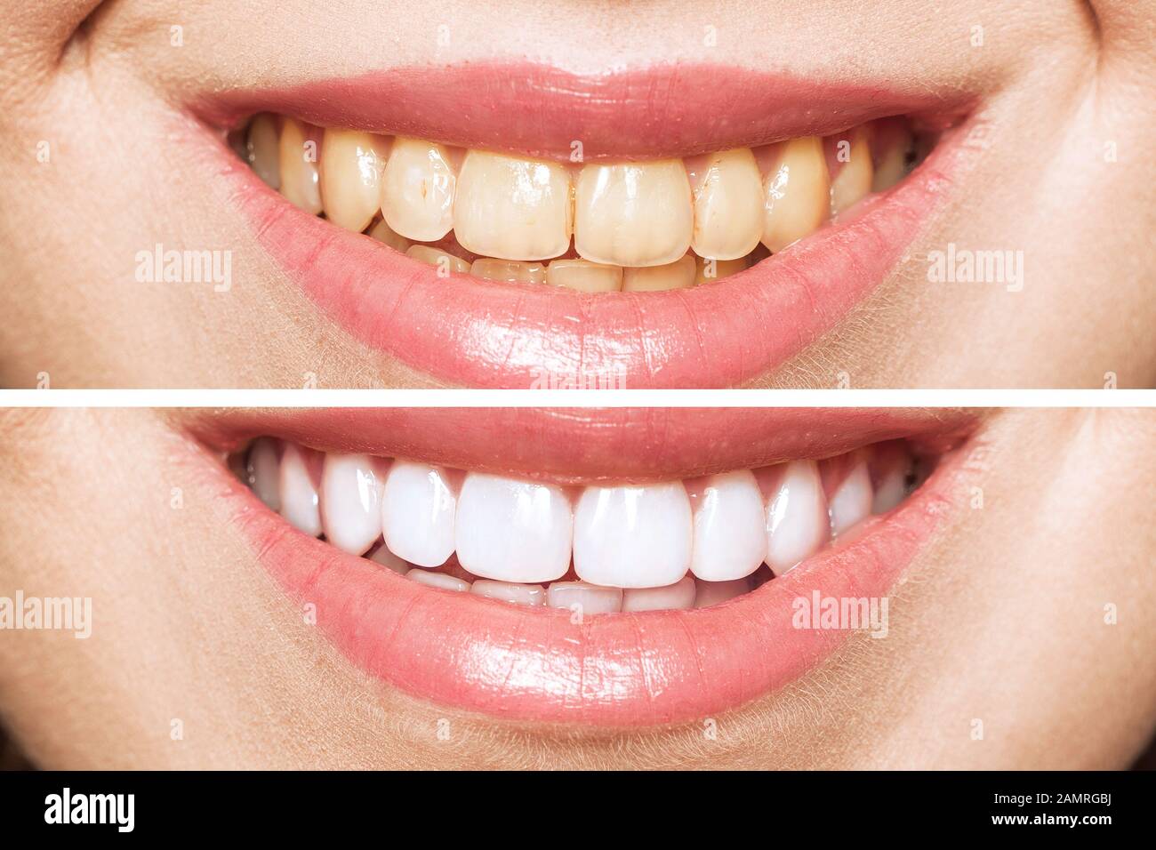 woman teeth before and after whitening. Over white background. Dental clinic patient. Image symbolizes oral care dentistry, stomatology Stock Photo
