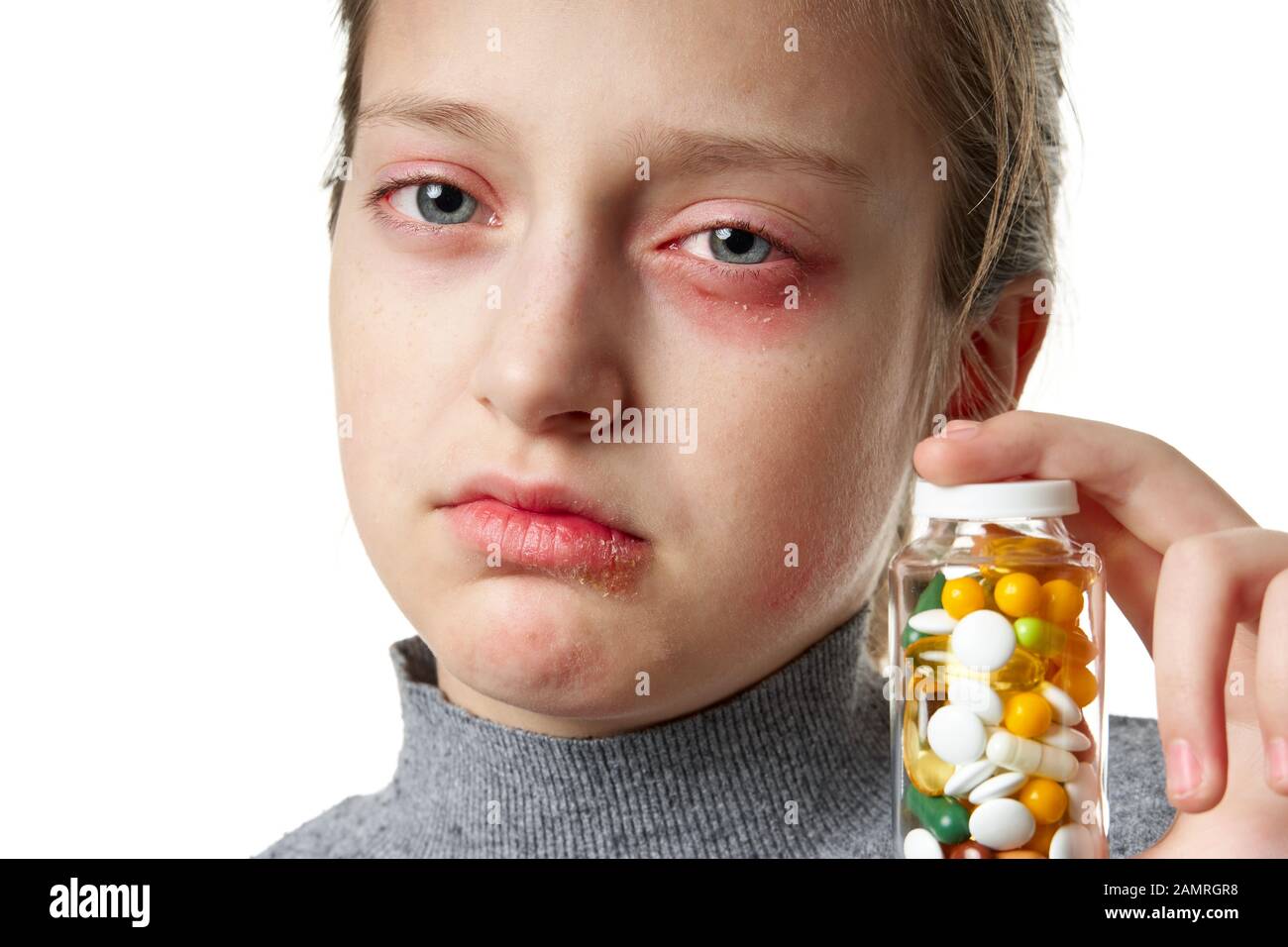 Allergic reaction, skin rash, close view portrait of a girl's face. Redness and inflammation of