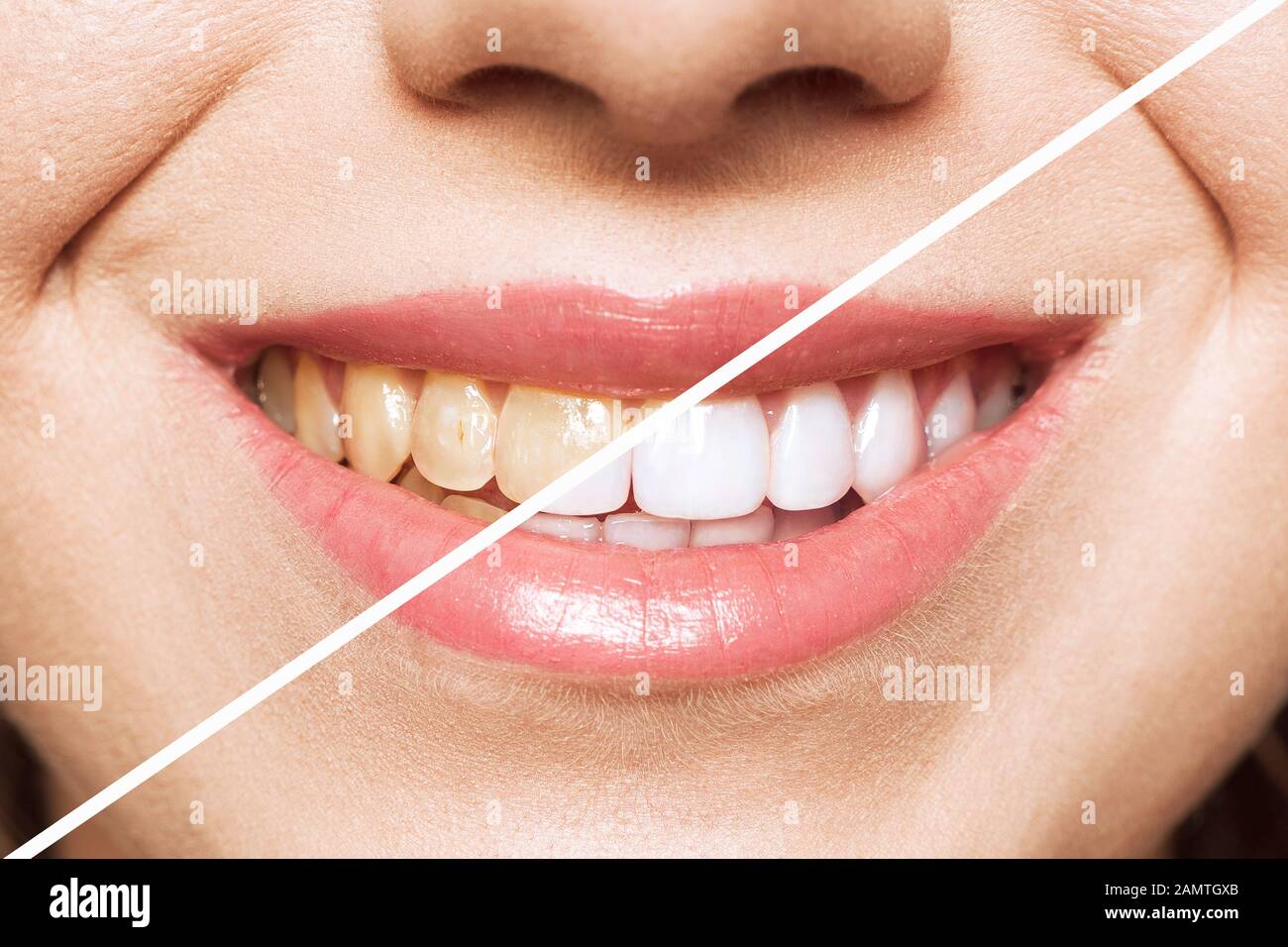 woman teeth before and after whitening. Over white background. Dental clinic patient. Image symbolizes oral care dentistry, stomatology Stock Photo