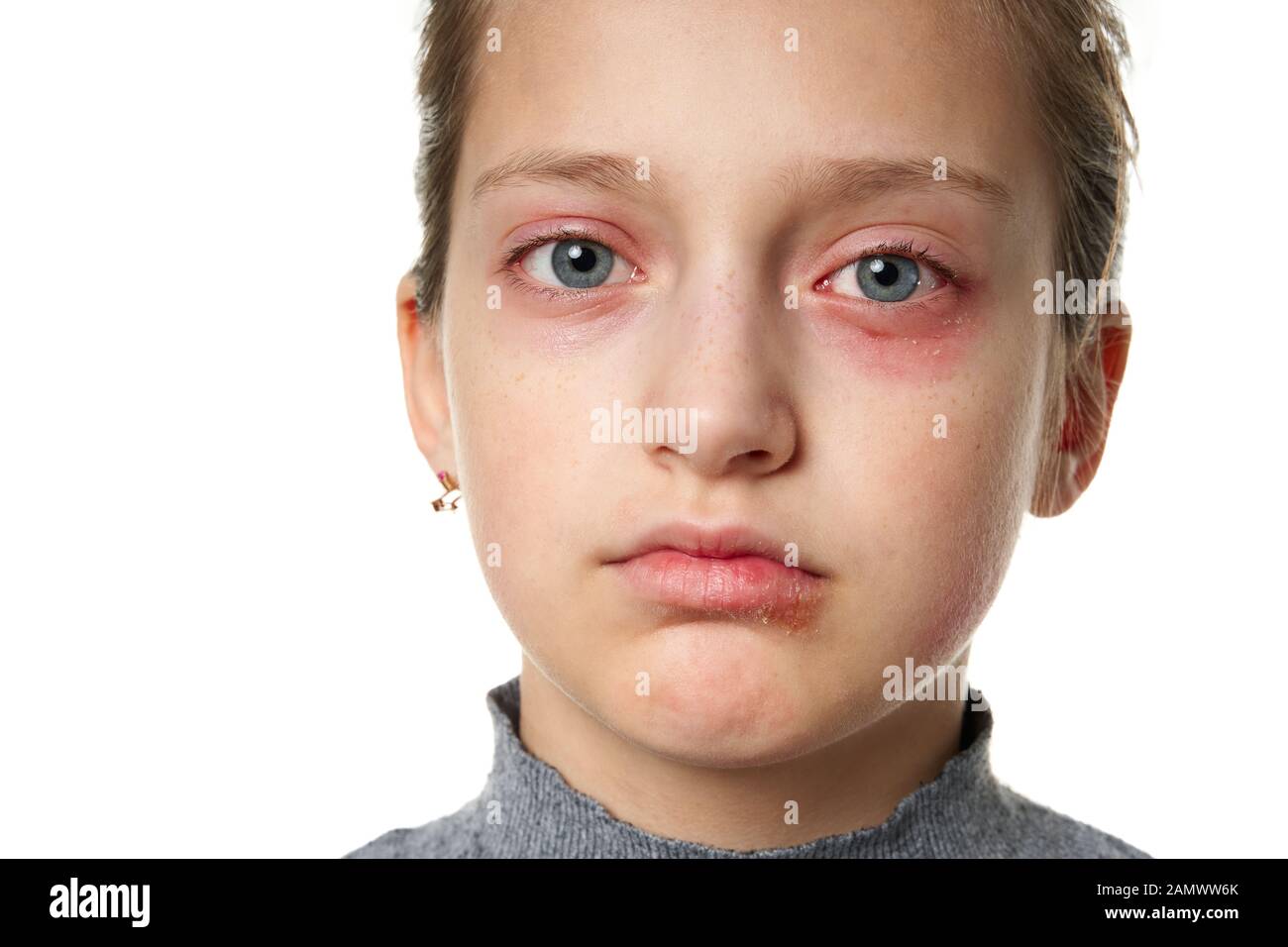 Allergic reaction, skin rash, close view portrait of a girl's face