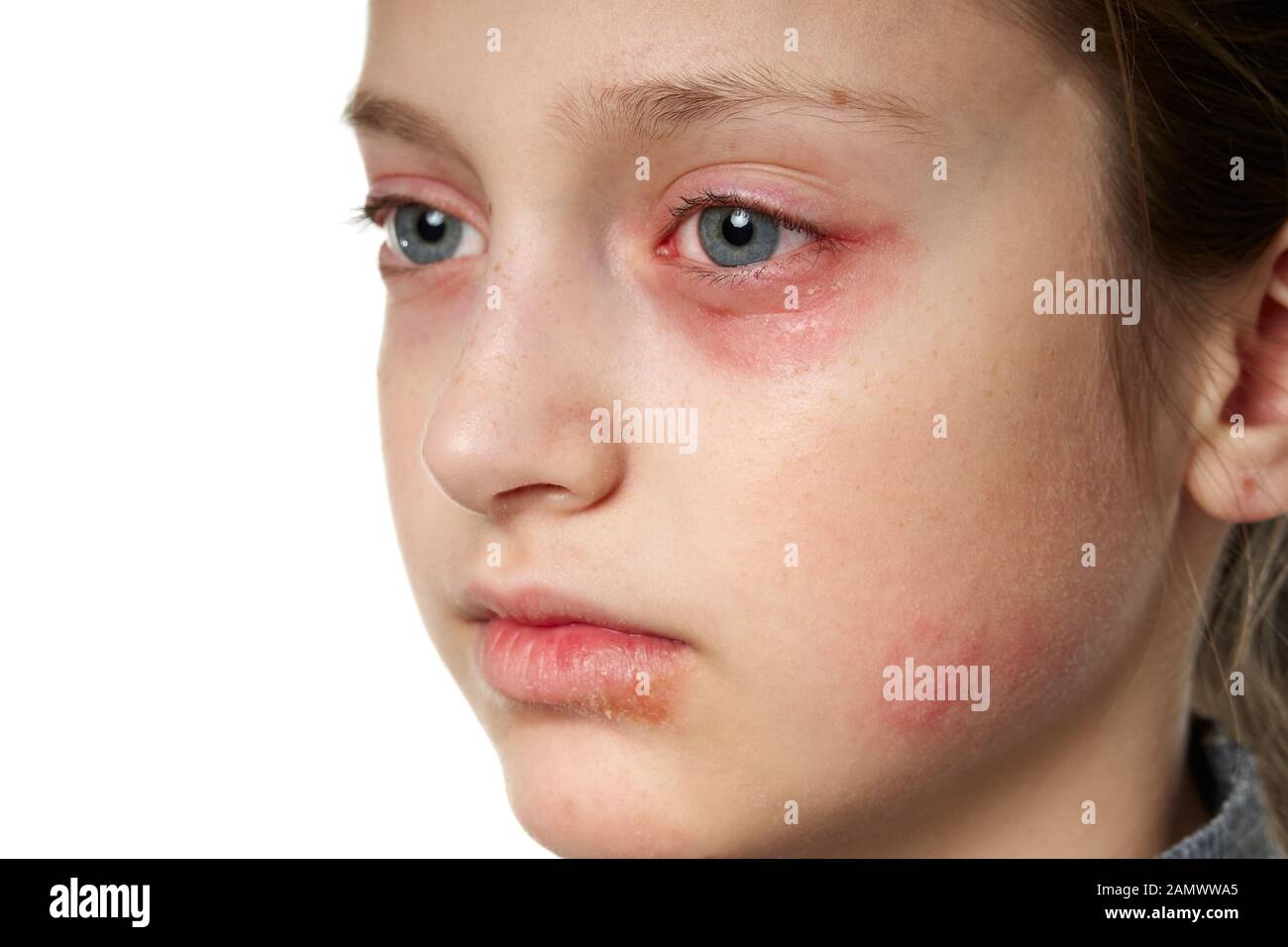 Allergic reaction, skin rash, close view portrait of a girl's face. Redness and inflammation of