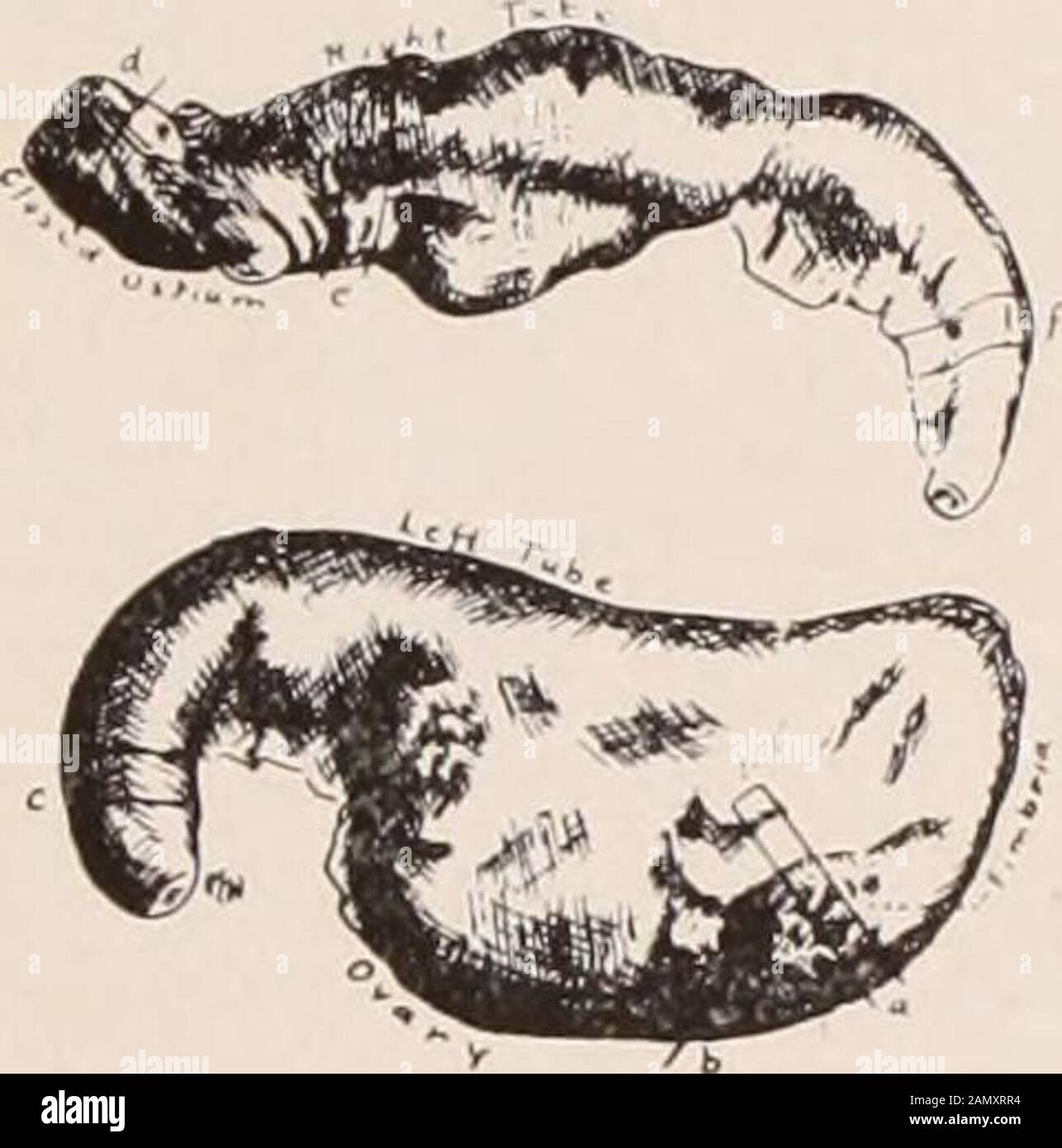 Transactions of the American Association of Obstetricians and Gynecologists for the year ... . Case XIII.Upper.—Drawing of gross specimen. Lower.—Photomicrograph of the dense pus cell infiltration of the corpus luteumshown at a in the drawing. Microscopic Examination.—Section (a) shows a typical corpusluteum of pregnancy with an extensive infection. The infection isin multiple foci, eight being counted in this section. In each thereare typical pus cell debris and hemolyzed red blood cells. Section (b) shows a wall with extensive connective tissue hyper-plasia. The mucosa exhibits two types of Stock Photo