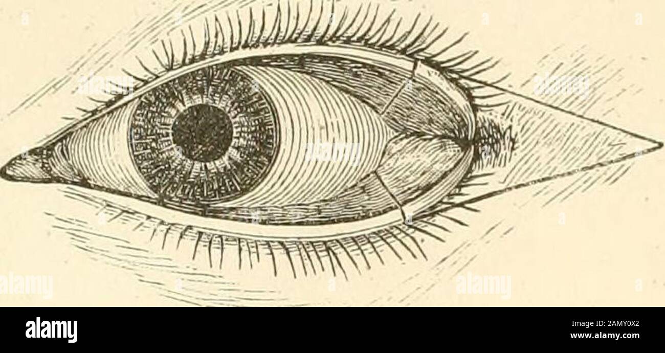 A treatise on the diseases of the eye . 49 DESCRIPTION OF PLATE IX. Figs. 155, 156—Represent Ectiiopium. from Caries of thf. Orbit, and Prof. AmmonsOperation for its Cure. (Seep. 146.) Fig. 157.—Illustration of Frickes Operation for Ectropium Br Transplantationof a portion of Skin. (See p. 147.) Figs. 158, 159.—Illustration of T. Wharton Jones Operation for Ectropium. (See Note, p. 147.) Pl. X. Fig. 160.. Fig. 161. Stock Photo