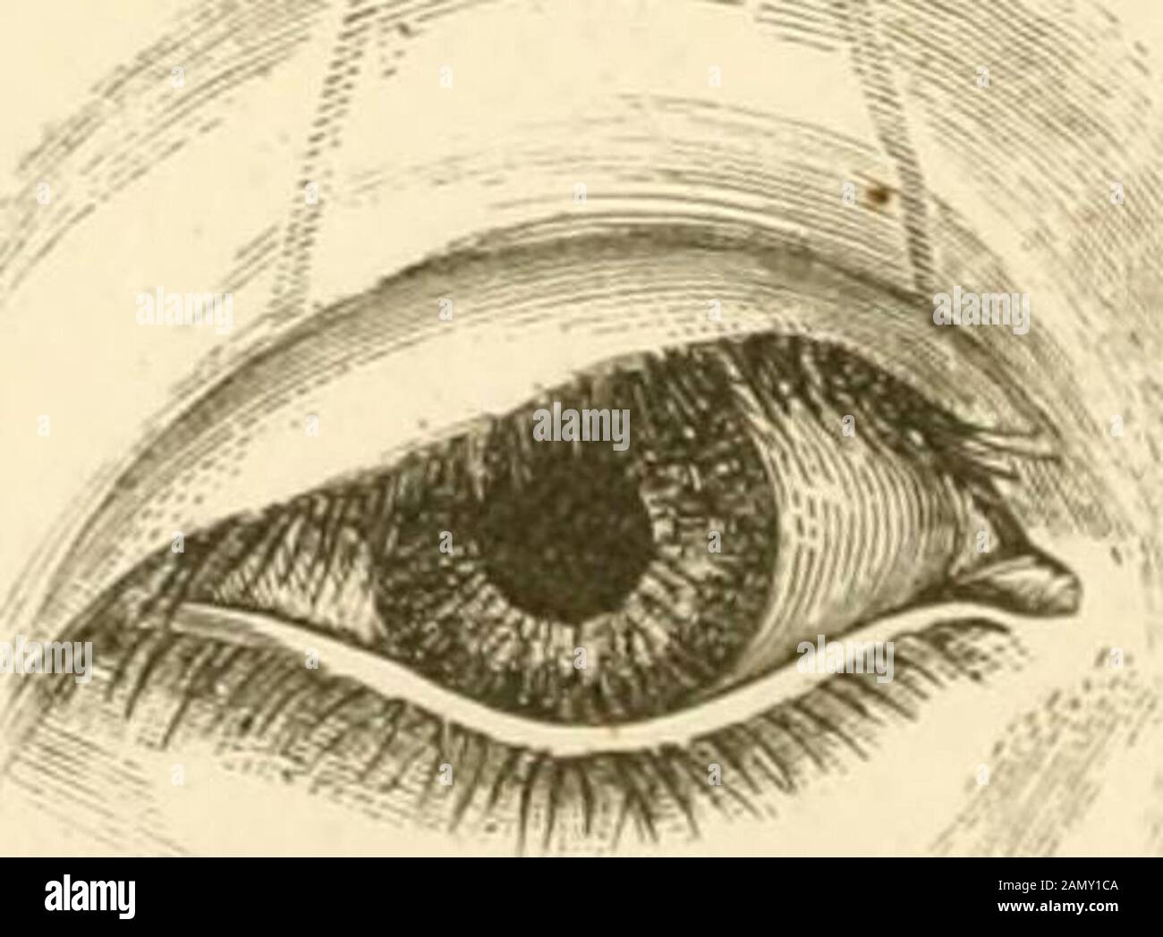 A treatise on the diseases of the eye . ^. 49 DESCRIPTION OF PLATE IX. Figs. 155, 156—Represent Ectiiopium. from Caries of thf. Orbit, and Prof. AmmonsOperation for its Cure. (Seep. 146.) Fig. 157.—Illustration of Frickes Operation for Ectropium Br Transplantationof a portion of Skin. (See p. 147.) Figs. 158, 159.—Illustration of T. Wharton Jones Operation for Ectropium. (See Note, p. 147.) Pl. X. Fig. 160. Stock Photo