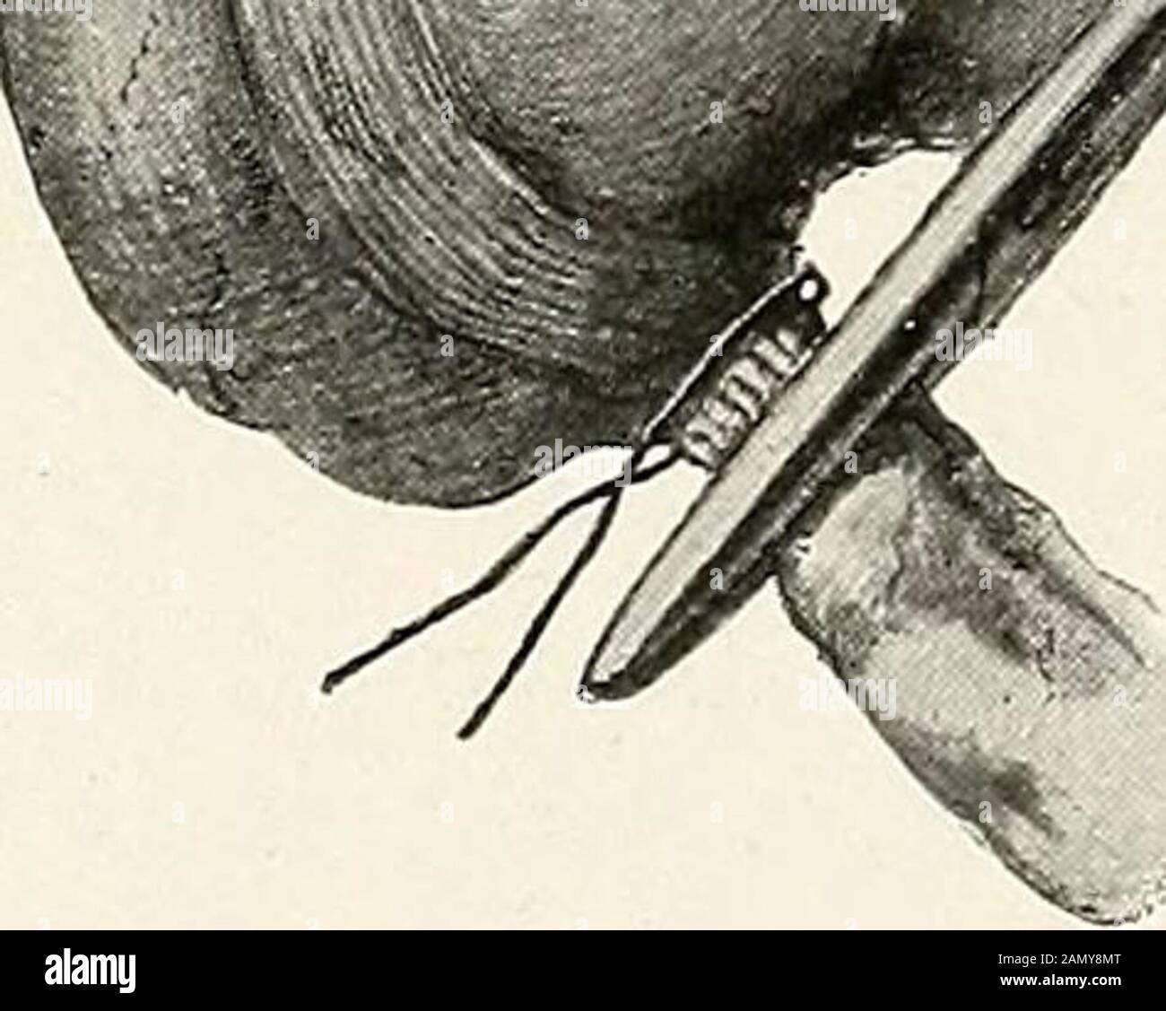 Appendix removal hi-res stock photography and images - Alamy
