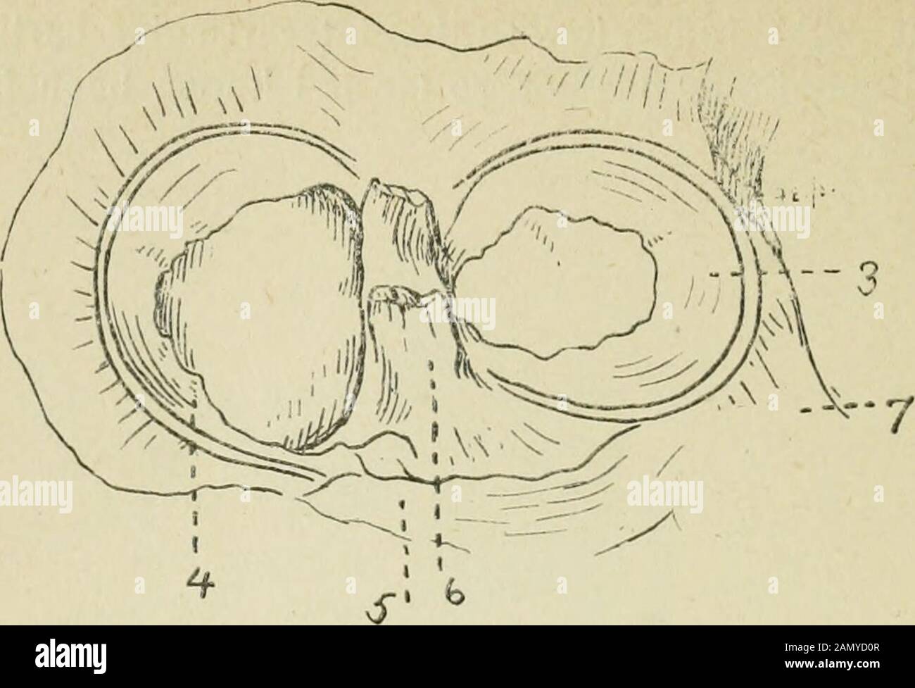 Annals of surgery . Fig. II.—Tibial Tendon of Biceps, Showing Its ...