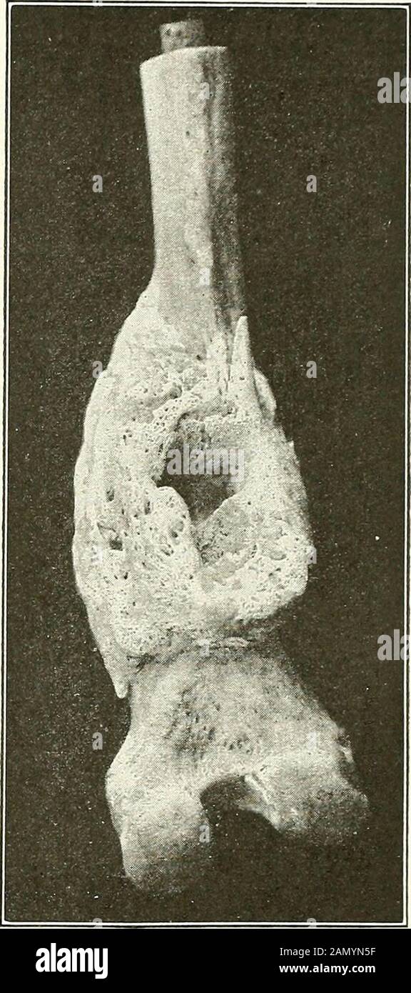 Gunshot injuries : how they are inflicted : their complications and treatment . Fig. 151. Fig. 152. Fig. 151.—Photograph in case of Pvt. D. C. S., Co. E, 20th Mass. Lower halves bones legsix months after injury. Tibia fractured by musket ball. Suppuration continued till amputationof limb six months later. Civil War specimen. No. 861 A. M. M. Fig. 152.—Photograph in case of W. A., Pvt. Co. L, 8th U. S. Inf. Gun-shot fracture re-ceived in action in Philippines, Dec, 1906. Nature of weapon unknown. Amputation Oct., 1908.Photograph represents femur after amputation, it shows the later bone lesions Stock Photo
