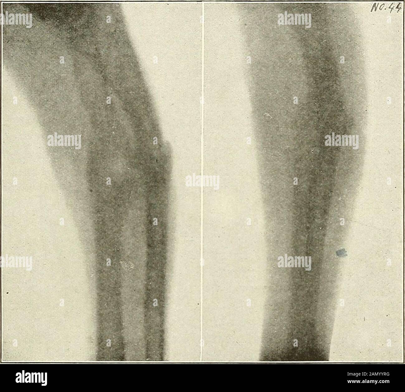 Gunshot injuries : how they are inflicted : their complications and treatment . aver. Bullet and metallic frag-ments from it are lodged. Army Med. School collection. Gibbs X-ray Laboratory. Fig. 142.—Fracture with detached fragments from .30 cal. Krag-Jorgensen bullet as a re-sult of slight grooving on internal border of bone. From Philippine Insurrection. Army MedicalSchool collection. in fractures involving the two bones. In such cases, the first bone hitfragments, and its spicula, acting as secondary missiles, make an im-pact with the projectile on the second bone causing more than the usua Stock Photo