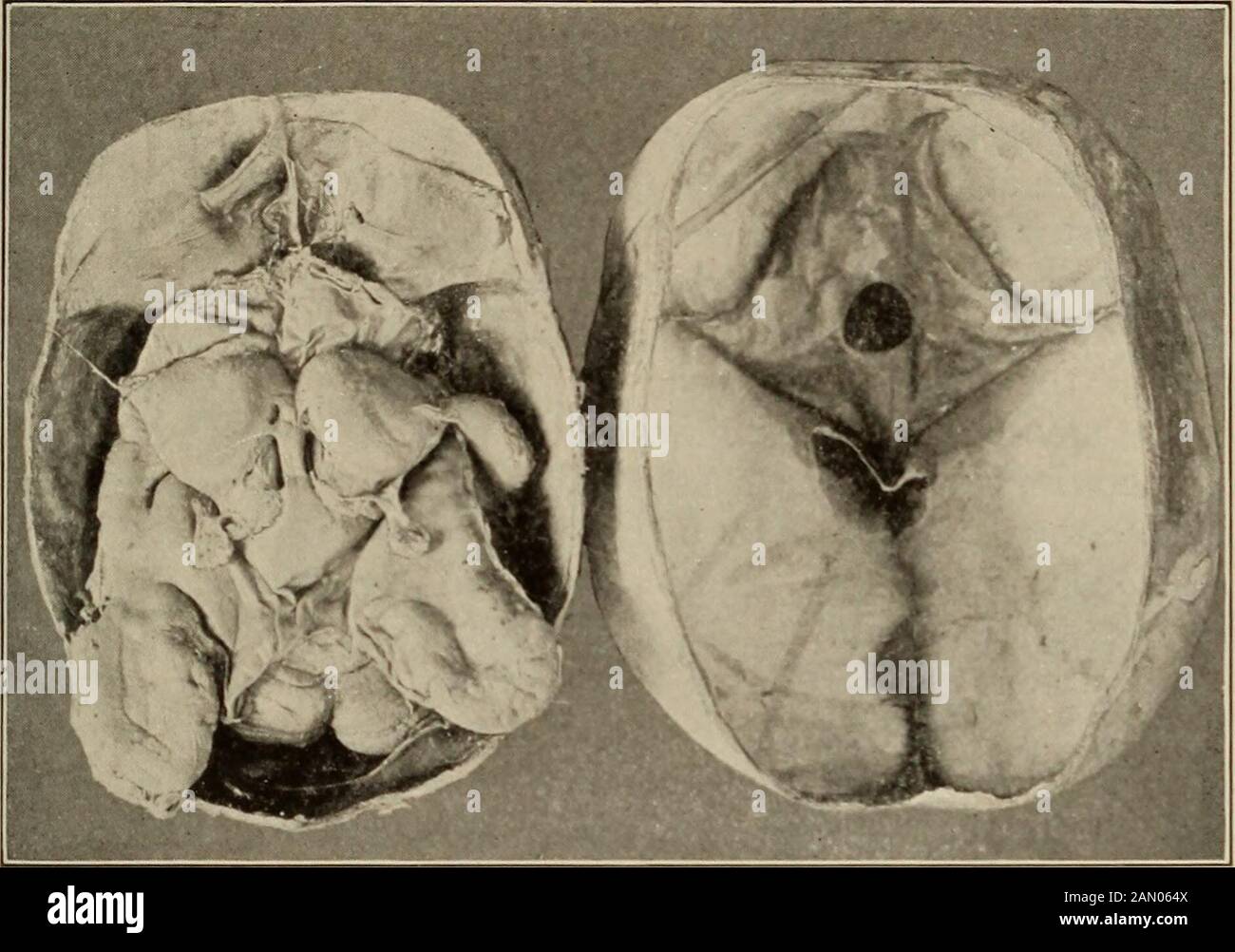 Nervous and mental diseases . ork Pathological Society. See Proceedings,1894, p. 94) : A female child, aged eighteen months; hydrocephalus, whether IDIOCY. 899 congenital or acquired unascertained. Circumference of head, 51.5 cm.;anteroposterior diameter, 18 cm. ; greatest transverse diameter, 15 cm.;naso-occipital arc, 32 cm. : binauricular arc, 34 cm. Blindness and nystagmus; widely gaping fontanels; spastic di-plegia ; occasional convulsions, and just before death opisthotonos.At the autopsy sixty-four ounces of reddish serum were first removedby tapping the anterior fontanel. The skull and Stock Photo