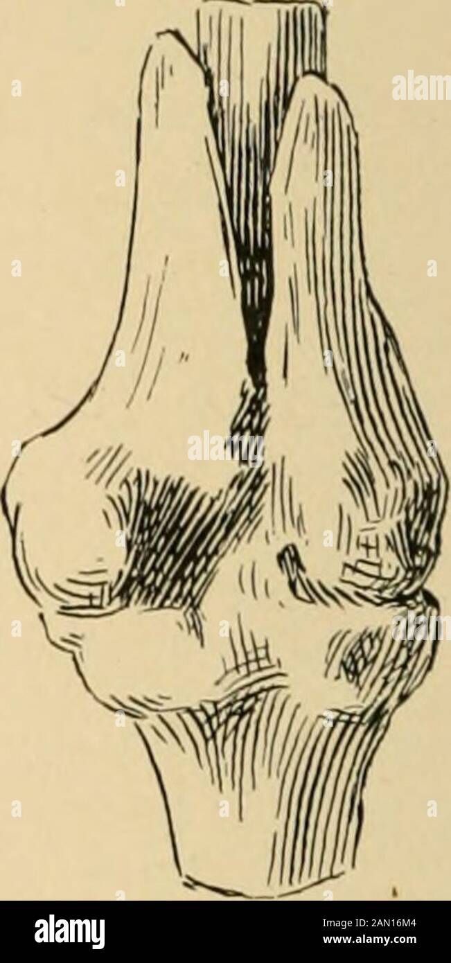 The treatment of fractures . Sequestrum. Fig. 418.—Oblique fracture of the shaftjust above the knee, with splitting apart ofthe two condyles. Extreme displacement;necrosis of tip of upper fragment. Patienta man of thirty-seven years, lived for fivemonths (Warren Museum, specimen 1118).. Fig. 419.—Same as figure 418, view frombehind. Upper fragment of femur. —- Lower fragment i femur. 1 Patella. Stock Photo
