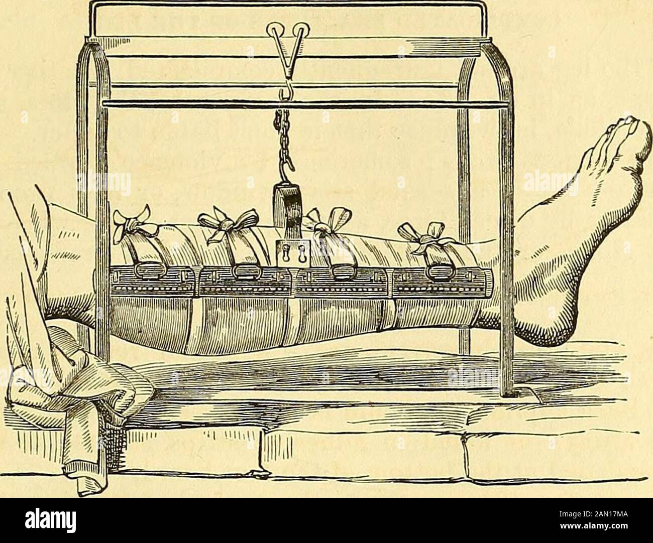 A system of surgery : pathological, diagnostic, therapeutic, and operative . ension. If, after the apparatus has been applied, the limbis not sufficiently steady, adhesive strips must be used, as represented in the en- graving Suspension of the leg may sometimes be advantageously practised, both as itrespects the comfort of the patient and the welfare of the fracture. It may bedone according to the method recommended, many years ago, by Professor N. E.Smith, or the very simple contrivance of Mr. Salter, of England, depicted in fig.432, representing the limb surrounded by the apparatus and slun Stock Photo