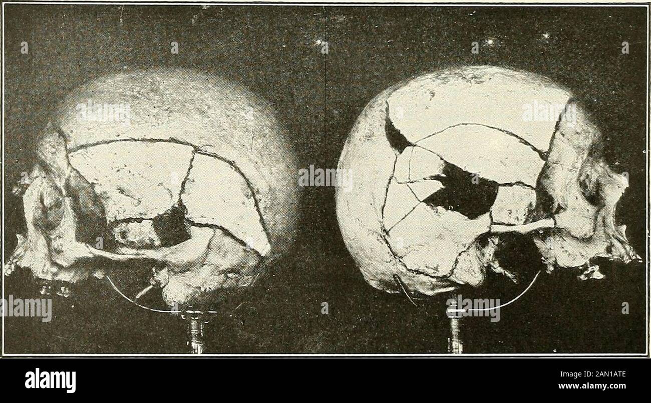Gunshot Bullet Wound High Resolution Stock Photography and Images Alamy