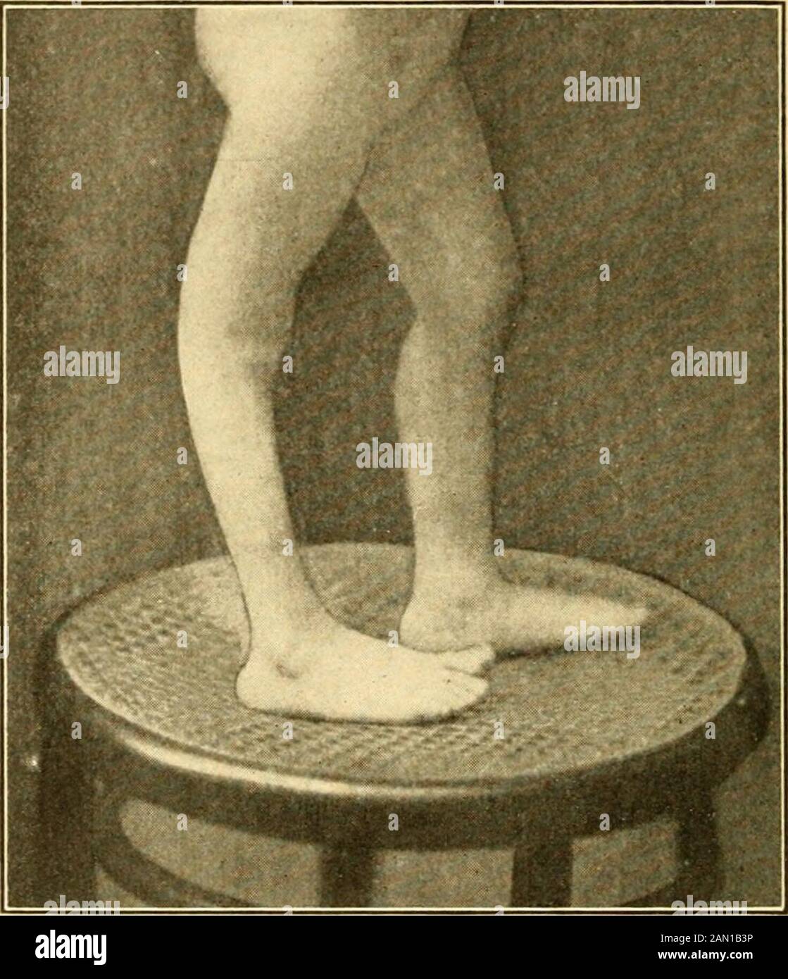Modern diagnosis and treatment of diseases of childern; a treatise on the medical and surgical diseases of infancy anf childhood . irst few weeks or months, it usually persists for life. The per-manently paralyzed structures soon begin to waste and undergofatty degeneration. The muscles are flabby and thin and thearticular bands so lax that the limb appears elongated and isprone to slip out of joint. Frequently there is also atrophy ofthe bones. As an immediate result of the atrophy of the diseased partsand the unopposed action (contraction) of the non-paralyzedantagonistic muscles, the affect Stock Photo