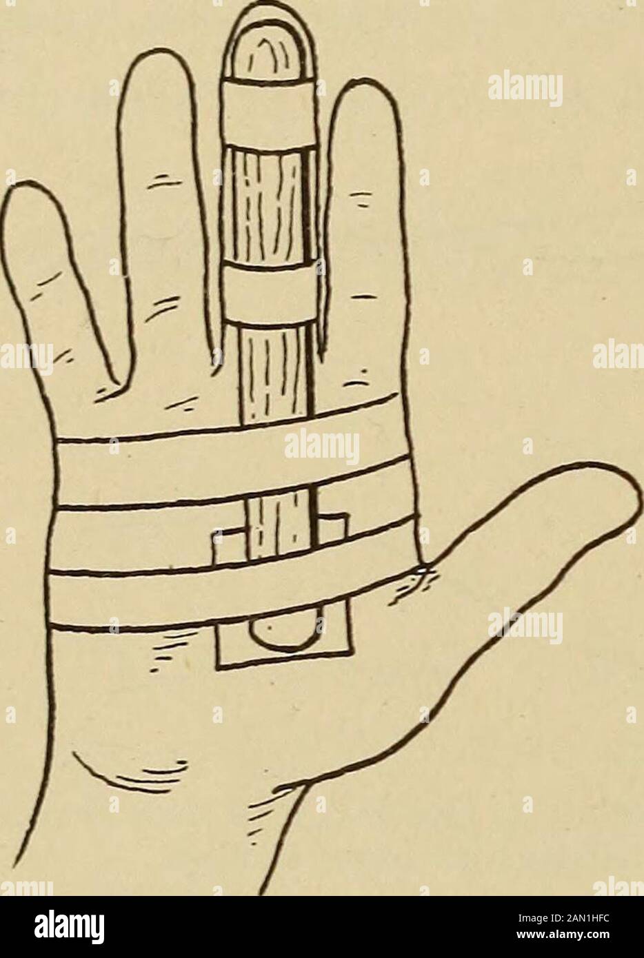 The home medical adviser, a popular work on the treatment of disease . na finger, unless the break is near a joint, when it may be mistaken for a dislocation. Pain, abnormal mo-tion, and grating between the fragmentsare observed. Treatment.—If there is deformity, itmay be corrected by pulling on the in-jured finger with one hand, while withthe other the fragments are pressed intoline. A narrow, padded wooden (halfthe thickness of a cigar box cover) or tinsplint is applied, as in Fig. 20, reachingfrom the middle of the palm to the fingertip. Anv existing displacement of the Fig. 20.—Fractuee of Stock Photo
