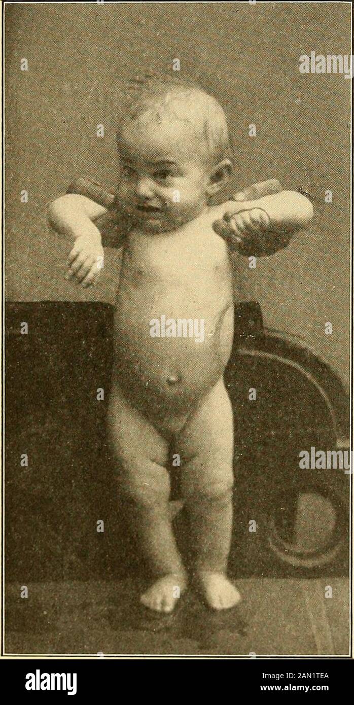 Modern diagnosis and treatment of diseases of childern; a treatise on the medical and surgical diseases of infancy anf childhood . the entire body is more or less involved. It closely resemblestuberculous adenitis, except that it is much less common thantuberculosis and that in the latter condition the glands show agreater tendency to caseation and suppuration. In doubtfulcases the tuberculin test may prove decisive in the diagnosis. The changes in the blood and the clinical manifestations are identical with those observed in anemia. Occasionally there are local pressure-symptoms, such as pain Stock Photo