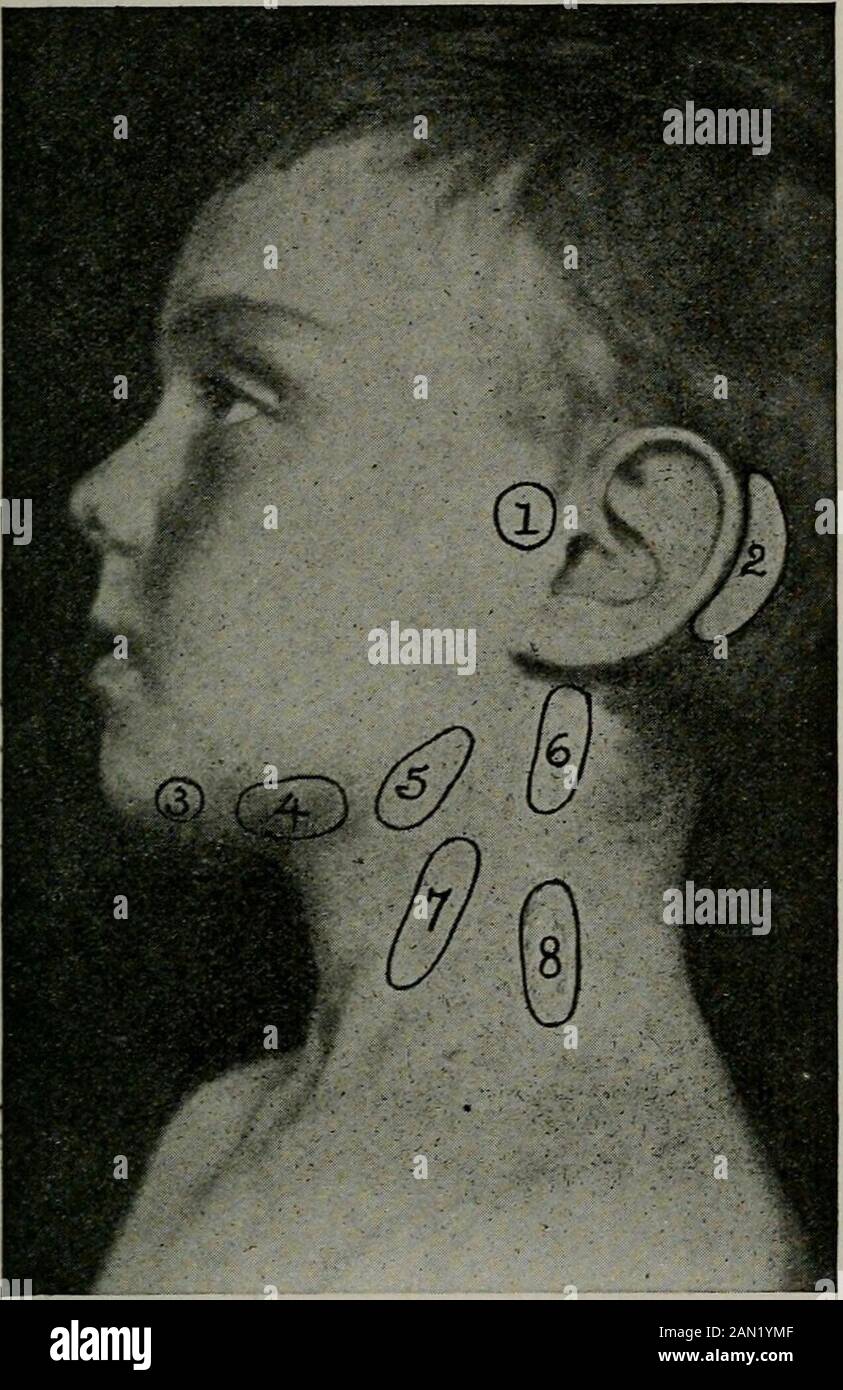Diseases of children, for nurses, including infant feeding, therapeutic measures employed in childhood, treatment for emergencies, prophylaxis, hygiene, and nursing . n. Pediculosis Capitis, or Lice.—Small parasites infest-ing the hair. Pediculosis Pubis.—Small parasites infesting pubic hair. Congenital ichthyosis is a disease of the skin in w^hichthere is an overgrowth of the epidermis forming a homysurface resembHng parchment. It may last through Ufe. Nursing.—To obtain results in skin diseases it is neces-sary to be patient and to apply the remedies thoroughly. All crusts should be immediat Stock Photo