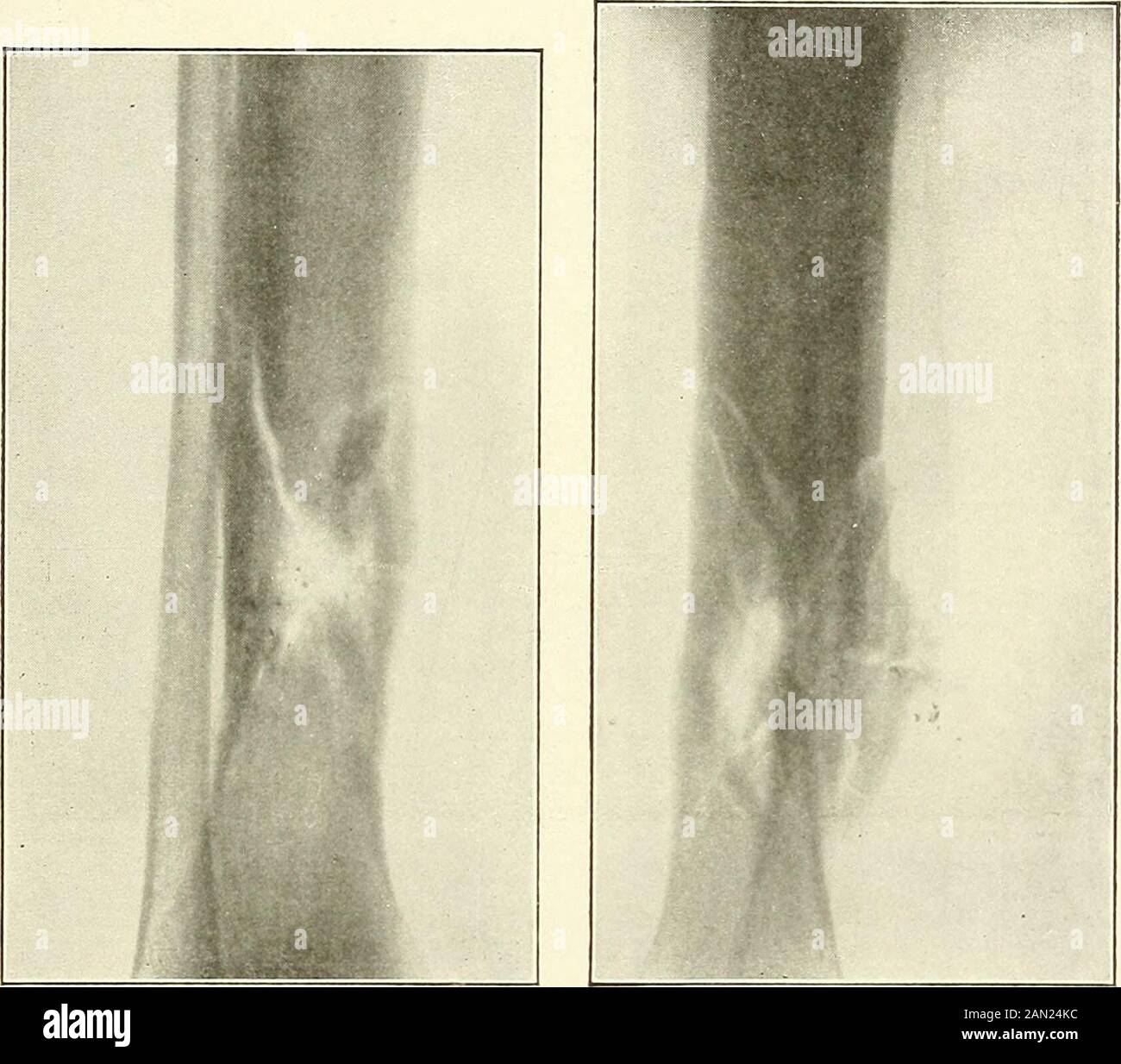 Gunshot injuries : how they are inflicted : their complications and ...