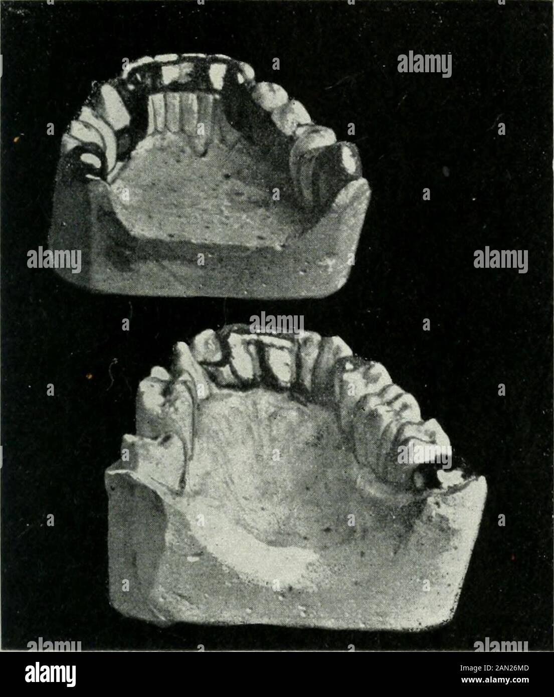 The tightening of loose teeth: some technical innovations . Lower and Uppkr Taw of a Mouth Badly Deformed byObliquity of the Teeth. (In the mouth for three years.) Procedure.— Upper Figure, Loiver Jaw.—Haii double-capped canines con-nected by means of splint; right and left bicuspid tube teeth. Loirer Figure, Upper Jarv.—After previous regulation,bridges serving as retaining appliances. Bight: Pure gold collar, tube tooth, collar on bicuspid. Left: Collar, crown, bicuspids, tube teeth. Front: Tube teeth. 67 PL ATE VTI. Lower and Upper Jaws : Loosening of Teeth due toUncleanliness and Powerful Stock Photo
