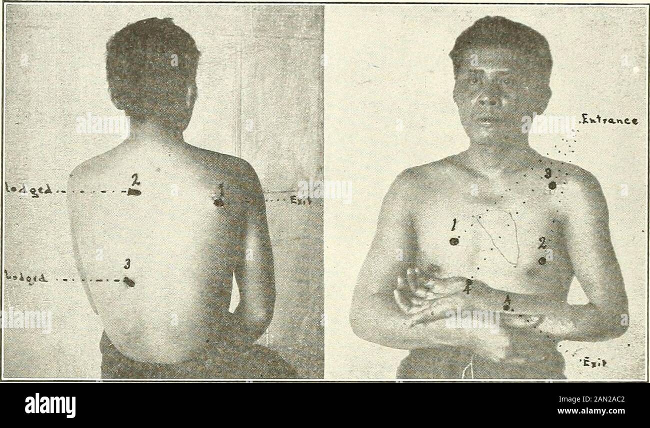 Gunshot injuries : how they are inflicted : their complications and ...