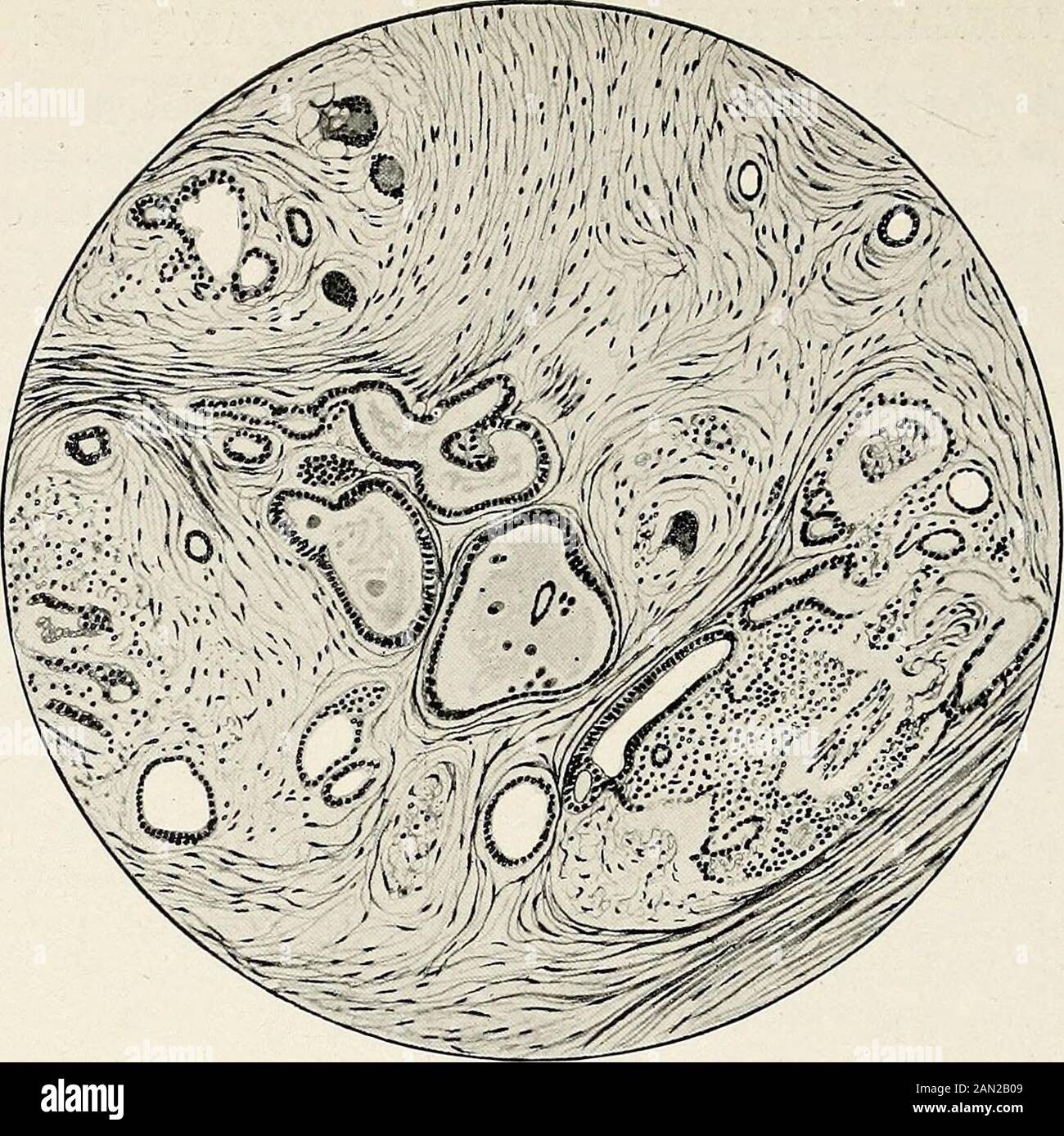 Gynaecology for students and practitioners . Fig. 337. Transverse Section of Tube through an Area of salpingitisisthmica nodosa. Note that the mucosal epithelium has penetrated themuscular strata, and appears as branching adenomatous follicles {salpingitis follicularis). muscular elements take on active hyperplasia in response to theirritation produced by the growing glandular tissue, and the result isa well-defined nodule. This process may spread into the interstitialpart of the tube, and may expand the tubal isthmus, so that at the. Fig. 338. Portion of Fig. 337 under a High Power. Note the Stock Photo