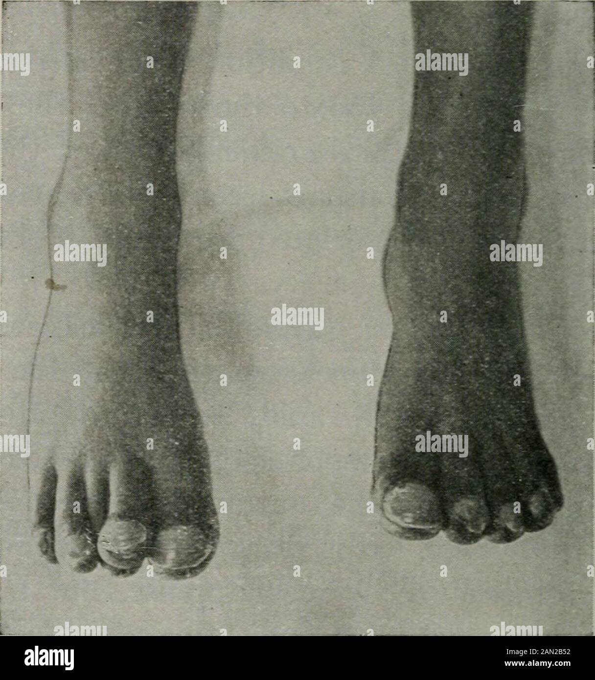 Diseases of children, for nurses, including infant feeding, therapeutic measures employed in childhood, treatment for emergencies, prophylaxis, hygiene, and nursing . Fig. 45.—The clubbed fingers of chronic heart disease.. Fig. 46.—Clubbing of toes in chronic heart disease. General Cyanosis.—Blueness of the surface frominsufficient oxidation of the blood. Clubbing of the fingers in chronic cases.  DISEASES OF THE CIRCULATORY SYSTEM 8l PERICARDITIS This is an inflammation of the pericardium or serouscovering of the heart. It is rare in infancy, but as thechild grows older it is not uncommon. I Stock Photo