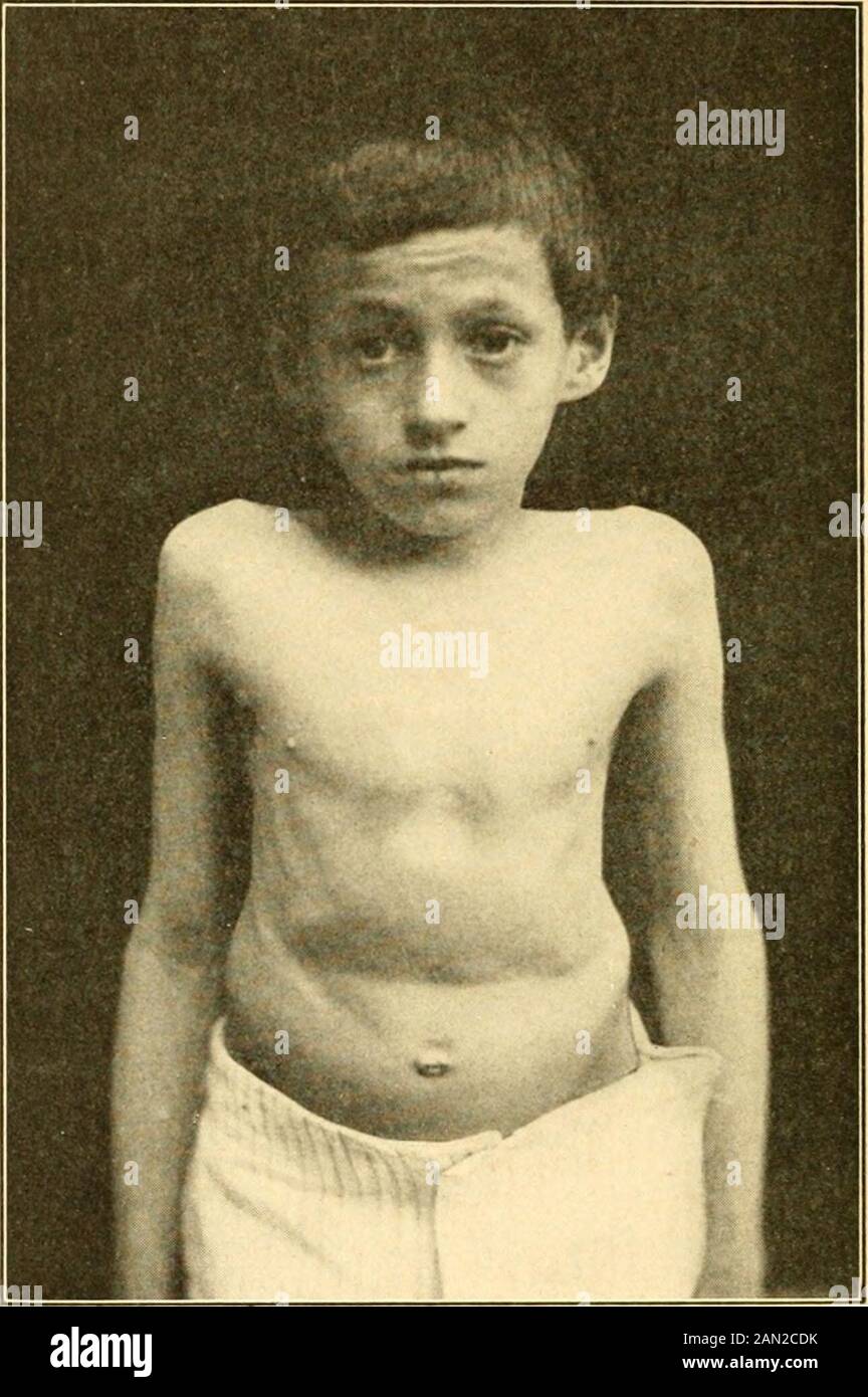 Modern diagnosis and treatment of diseases of childern; a treatise on the medical and surgical diseases of infancy anf childhood . Spondylitis. Gibbus (12 years old).(Sheffield.) brse are diseased, there is danger of anterior displacement of thehead between the atlas and axis, more rarely between theocciput and atlas, and deatli from pressure upon the cord. Thepermanent deformity in cervical spondylitis usually consists ofthickening and broadening of the neck, and sinking of the headupon the shoulders. In dorsal spondylitis the distribution of the pain differs some- Dorea]what with the particu Stock Photo