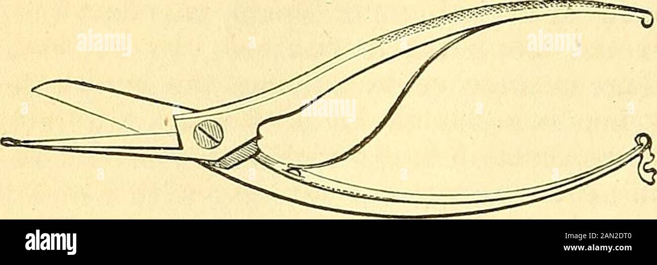 A system of surgery : pathological, diagnostic, therapeutic, and operative . f the tibia, by means of Fig- 348. Seutins scissors, repiesented in fig 348, one of the blades of whichis probe-pointed, and, therefore,well adapted to the object. Thelimb being properly supported byan assistant, the hardened shell isgently peeled off from its surface,which is next carefully spongedwith alcohol and laudanum, orspirits of camphor, when the apparatus is immediately reapplied with the aid ofa roller. Thus, bj simply removing the bandage from time to time, an opportu-nity is afforded of inspecting the lim Stock Photo