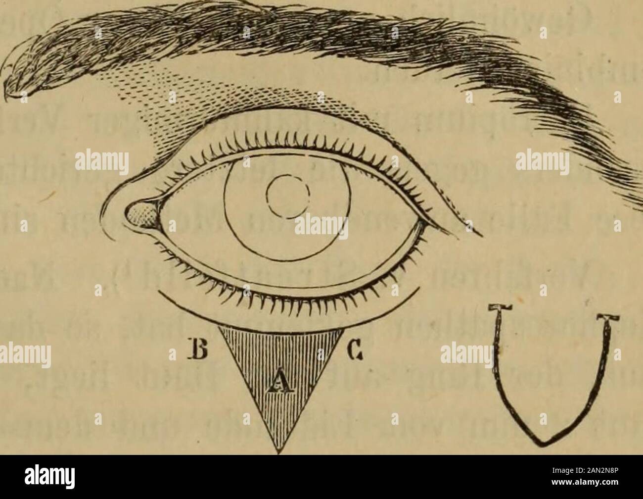 Handbuch der Augenheilkunde . ^ Fig. 201. Entropiumoperation. Ausschneidungvon Hautstückchen. Fig. 202. Entropiumoperation nach v. Graefe. 3 mm Entfernung vom Lidrande und demselben parallel verläuft ein jeder-seits bis auf 3 oder 4 mm sich den Lidcommissuren nähernder Hautschnitt,derselbe bildet die Basis eines dreieckigen Hautlappens A, welcher abge-tragen wird, worauf man die Känder des Lappens B und C ein weniglockert und mit zwei oder drei Knopfnähten schliesst; der horizontal ver-laufende Schnitt wird sich selbst überlassen. Die Breite und Höhe des zu excidirenden Lappens richten sich na Stock Photo