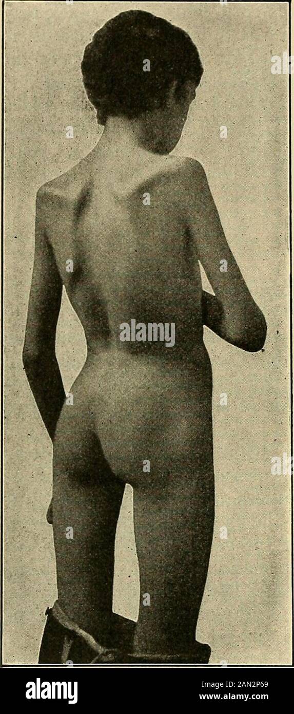 Organic and functional nervous diseases; a text-book of neurology . ork.Examination in January, 1897,showed a very marked condition ofatrophy with corresponding paral-ysis in the muscles of both upper ex-tremities, chest, scapulae, and back,as shown in the picture. (Fig.144.) No muscle was entirely para-lyzed, but all the muscles were ex-tremely weak, presented fibrillarycontractions on exposure to cold oron percussion, but did not showany reaction of degeneration. Theatrophy was most extreme aboutthe muscles of the scapulae and inthe deltoids and upper part of the arms. The muscles of the tho Stock Photo