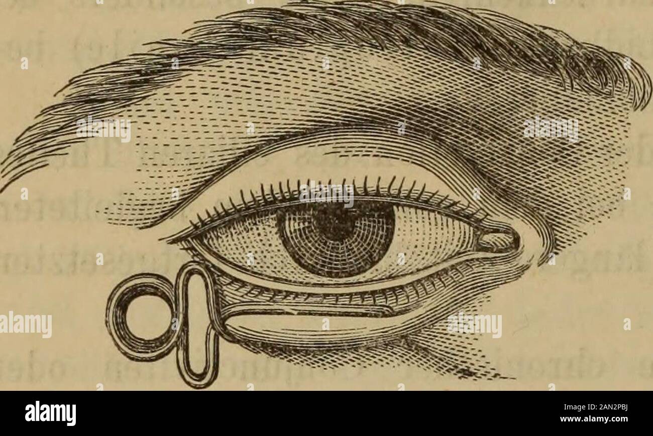 Handbuch der Augenheilkunde . dgl.,genügen ein paar Streifen englischen Pflasters, das Lid wieder nach aussenzu kehren. Ein für solche Fälle zweckmässiges Mittel besteht darin, einekleine Charpiekugel zwischen knöchernem Augenhöhlenrand und dem Lidedurch ein paar Heftpflaster streifen zu befestigen. Arlt1) räth folgenden Verband. Ein anderthalb Zoll langer undeinen halben Zoll breiter Leinwandstreifen wird mit einem Ende unterhalbdes medialen Augenwinkels zwischen Augenhöhlenrand und convexem Randedes Tarsus mittels Collodium befestigt, sodann der Streifen stark voninnen nach aussen nach dem ä Stock Photo