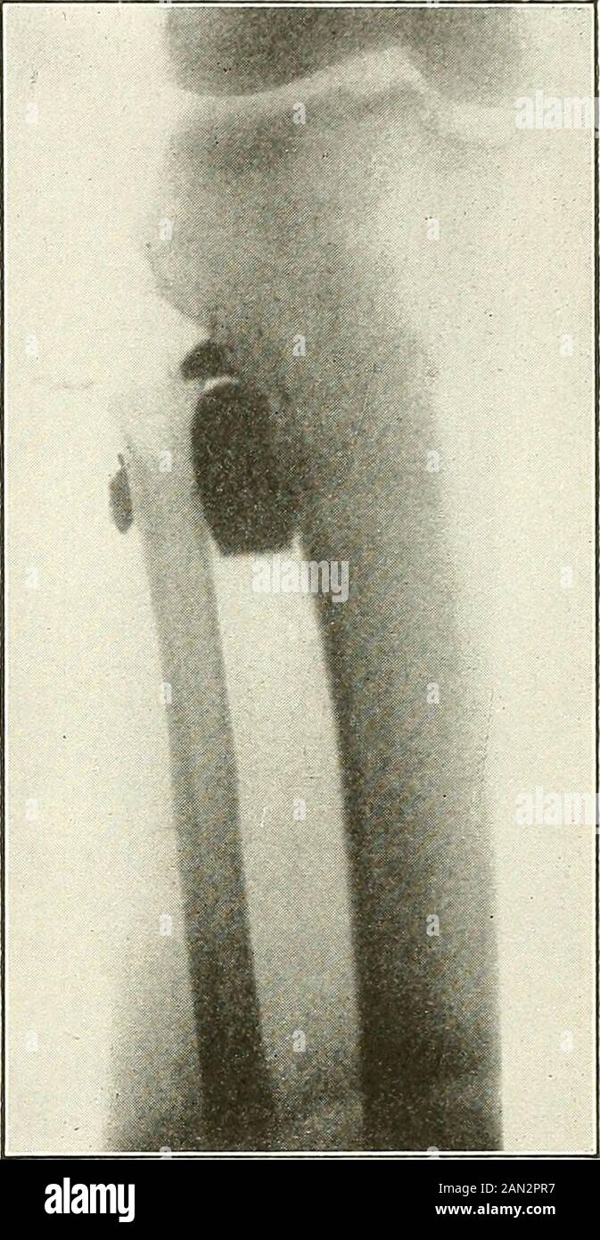 Gunshot injuries : how they are inflicted : their complications and treatment . Fig. 21. Fig. 22. Fig. 21.—Caliber .50 conoidal bullet lodged against plantar surface right foot. Partial frac-ture of cuboid and cuneiform bones. Primary amputation by Choparts method. Died ninthday of typhoid fever. No. 6531 A. M. M. Specimen from Civil War, 1861-65. Fig. 22.—X-ray print of left leg of a Civil War (1861-65) veteran showing lodged large caliber,soft lead, fragmented bullet, lying between tibia and fibula anteriorly just below superior fibulo-tibial articulation, where it can be easily palpated. Mi Stock Photo