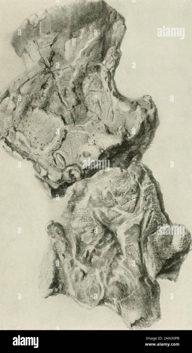 Annals of medical history . Man, Amer. Geol., mm, vol. xwiii. |&gt;|). 5&gt;-t-- K- ? Studies in Paleopathology 39i the specimen later, suggested that it mighthave been a fracture with callus andnecrosis. 8. Fistula are evident in the lower jawof an ancient and primitive whalefrom the Eocene ofEgypt, and an en-largement of themandible of athree-toed horsefrom the Mioceneof North Americaindicates the pres-ence of a fistula,possibly due toactinomycosis, i nits early stages.Dental fistulse areoccasionally seenamong the knownremains of fossilman, often result-ing in the loss ofteeth. 9. Rickets is Stock Photo