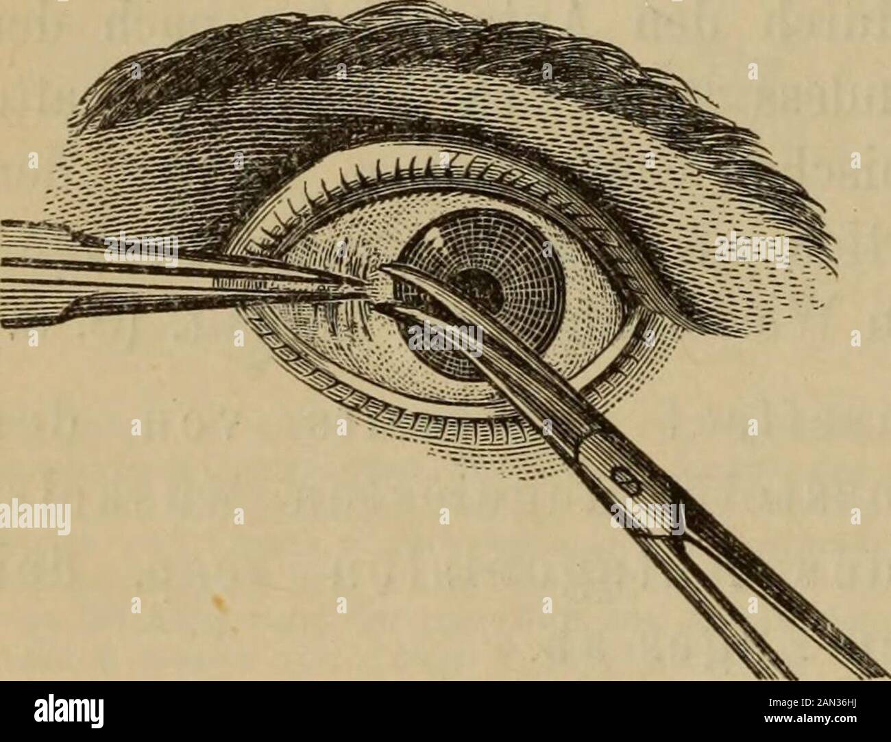 Handbuch der Augenheilkunde . mit Seiden- oder Catgutfaden (für die Fälle,in denen eine Conjunctivalnaht erforderlich ist). Erster Act. Schnitt durch die Conjunctiva. (Fig. 178.) NachEinlegung des Sperrelevateurs erfässt man mit der in der linken Hand ge-haltenen Pincette dicht am innernHornhautrande eine Conjunctivfalte undschneidet sie in verticaler Eichtung ein;die coneave Fläche der Scheere ist dabeigegen den Bulbus, die stumpfe Spitzegegen den innern Augenwinkel ge-richtet. Dann führt man die Scheeren-spitze in die Conjunctivalwunde einund trennt mit kurzen Schlägen dassubmueöse Zellgeweb Stock Photo