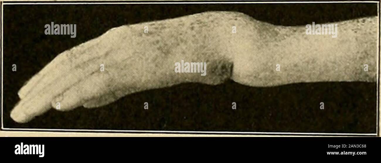 The treatment of fractures . Fig. 287.—Colles fracture, radial side. Marked crease at base of thumb. Dorsal and palmar prominences.. Fig. 28S.—Colles fracture, ulnar side. Absence of ulna on the dorsum of the wrist ; presenceanteriorly. Marked crease in front of displaced ulna. Dorsal prominence marked. and flexion, extension, abduction, and adduction of the handshould be carefully performed. These simple observationsquickly made upon the normal wrist enable one to establish astandard for comparison with the injured wrist. In ever}- case 222 FRACTURES OF THE BONES OF THE FOREARM in which there Stock Photo