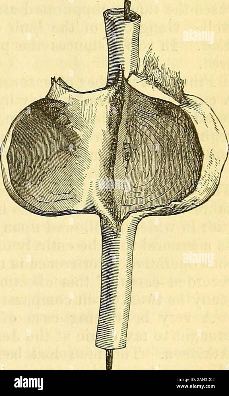 A system of surgery : pathological, diagnostic, therapeutic, and operative . before the pro-fession. In the case of a negress, aged thirty-two, who was under the joint care of my sonand myself, in 1859, on account of a large aneurism of the upper third of thefemoral artery, the assistants succeeded in effecting complete solidification ofthe contents of the sac in forty-six hours, by digital compression alone. Thetumor progressed most favorably, and in less than three weeks after the opera-tion, the woman was able to walk about the house. In this case, referred to ina previous section, there wa Stock Photo