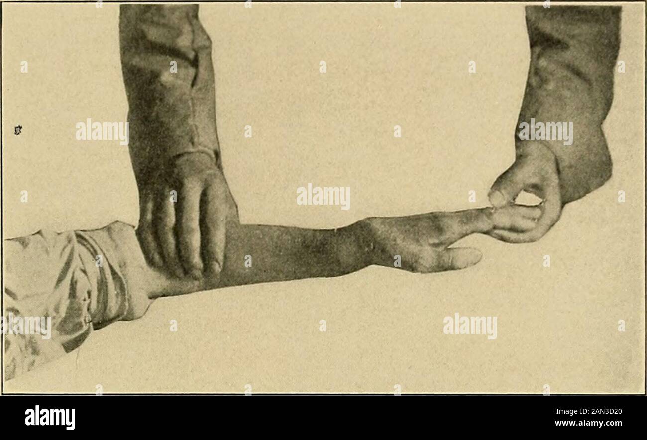 The treatment of fractures . Fig. 285.—Colles fracture the common