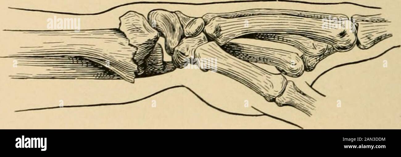 The treatment of fractures . Fig. 284.—Diagram of fracture of base of radius with anterior displacement: reversedColles fracture (term suggested by Roberts).. Fig. 285.—Colles fracture: the common silver-fork deformity. Note dorsal and palmarprominences (diagram). radius is found to be a little lower (nearer the hand) than the tipof the styloid process of the ulna. To ascertain the relative posi-tion of the styloid processes, the injured wrist should be graspedby the two hands and the styloids felt by the tips of the fore-fingers. The styloid process of the radius and the shaft imme-diately ab Stock Photo