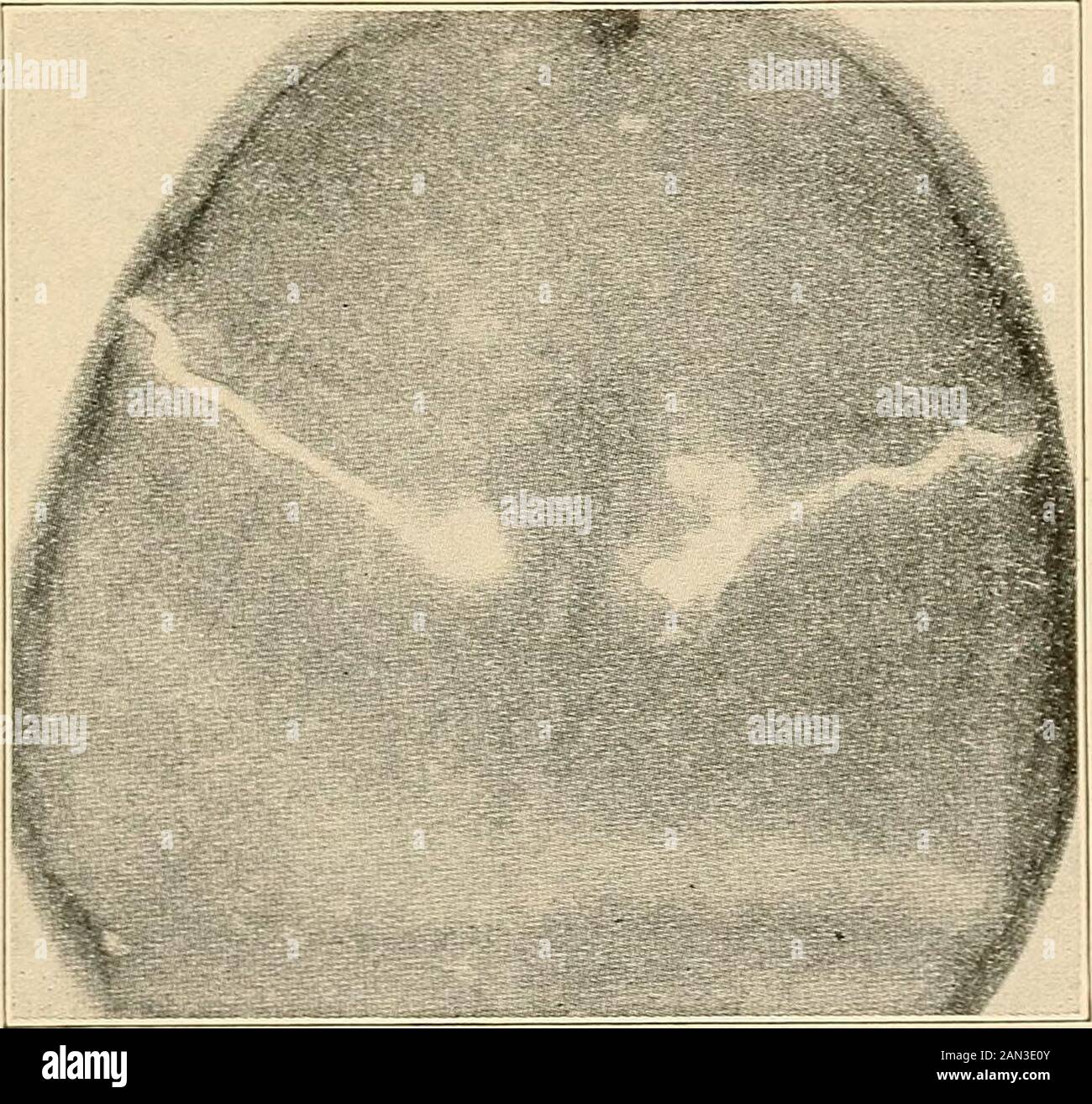 Roentgen diagnosis of diseases of the head . he skull(through the right foramen parietale) and in the diploe, in thecase of a large tumor of the right cerebral hemisphere which 21In one of the cases demonstrated to us by Barany, there existed a mastoid emis-sary on the right Mile the size of the little linger. From this a very plainly visible andpalpable vein made its exit, pulsating synchronously with the systole. INTRACRANIAL DISEASES 231 had eroded the inner surface of the skull. Smith referred to thefact that, in the people of the Balkan peninsula, the retrobreg-matic Pacchionian grooves a Stock Photo
