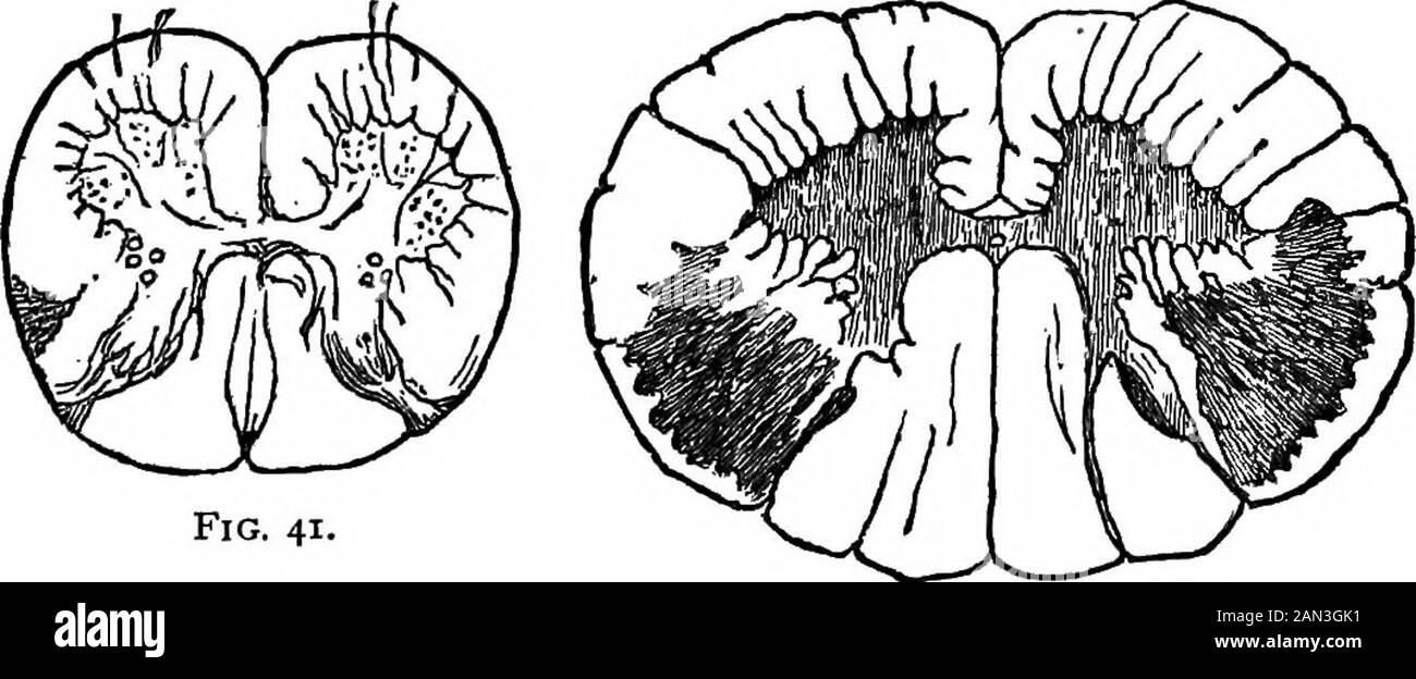 Lectures on localization in diseases of the brain, delivered at the Faculté de médecine, Paris, 1875 . FlG. 40. Fig. 39. , Fig. 39.—Transverse section of the spinal cord in a case of consecutive lateral fas-cicular sclerosis ; from softening of the optico-striated bodies and the internal capsule.(Cervical region.) Fig. 40.—^Transverse section of the spinal cord in a. case of consecutive lateralfascicular sclerosis. (Dorsal region.) sis invades also the spinal fibres of the lateral fasciculus (com-pare Figs. 39, 40, and 41, and Figs. 42, 43, and 44).. Fig. 41, Fig. 42. Fig. 41.—Transverse sec Stock Photo