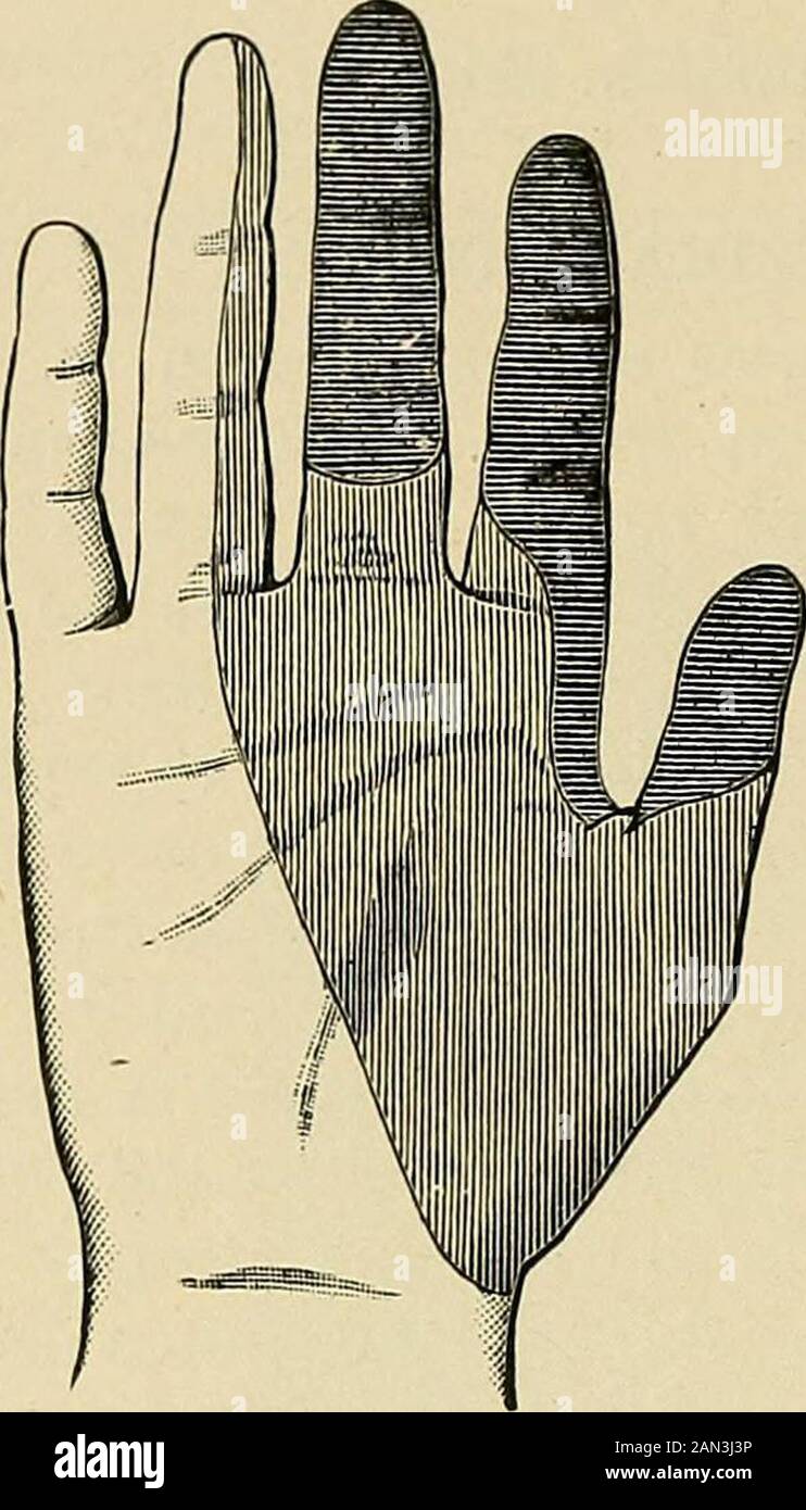 Organic and functional nervous diseases; a text-book of neurology . f of the deep flexors of the flngers, the musclesof the little finger, the interossei, the inner two lumbricales, and theadductors of the thumb. The result of paralysis of the ulnar flexor of the wrist is not verymanifest, as other muscles are capable of doing the work of theflexor carpi ulnaris. A paralysis of the flexor profundus digitorummakes the patient incapable of flexing the first phalanges of the littleand ring fingers, hence there is no opposition to their extreme exten-sion, and part of the deformity of the hand res Stock Photo