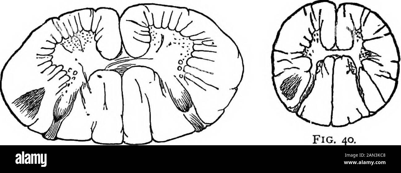 Lectures on localization in diseases of the brain, delivered at the Faculté de médecine, Paris, 1875 . e analogies are considerable, since the same alteration(gray induration) is in both cases located in the same tissue.But there are also variations worthy of notice ; thus, in prim-itive sclerosis the fascicular lesions are necessarily double, that Those cases where the extension of the lesion exceeds its habitual limits, theinvasion, for example, of the anterior gray cornua, which will be considered fartheron, are certainly among the most decisive arguments which can be employed toestablish Stock Photo