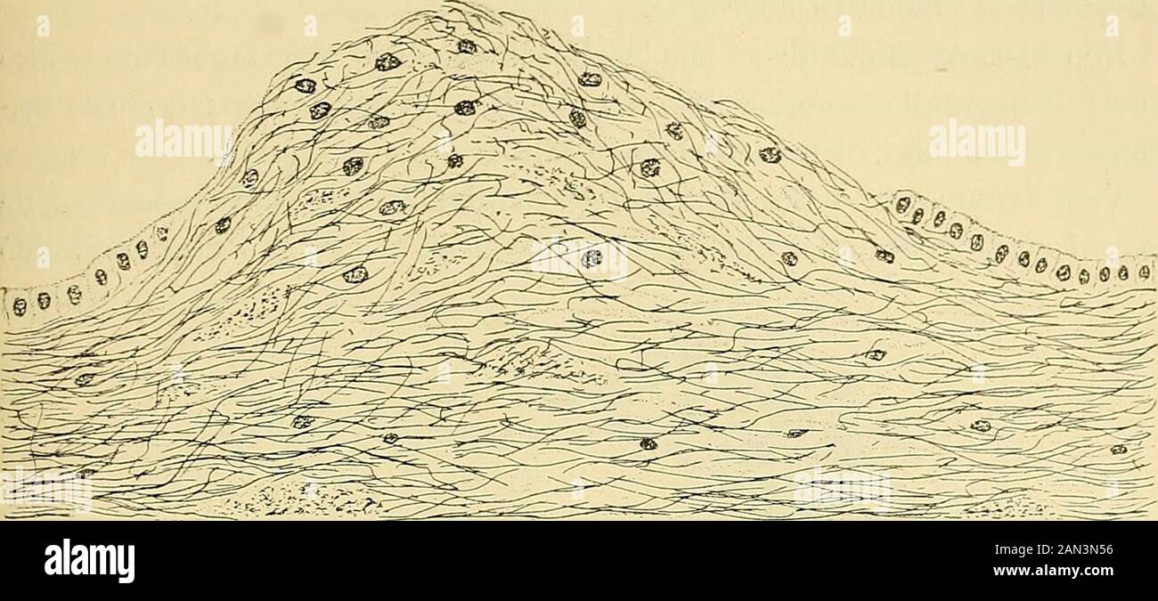 Trattato delle malattie mentali . velletto, dove qualche cellula di Purkinje è cir-condata da robusti panieri di nevroglia e lo strato molecolare contienemolte fibre di Bergmann. Talvolta si vede il paniere e la cellula è distrutta.Nello strato dei granuli, che normalmente è privo di fibre, se ne vedeuna discreta quantità. Tra le lesioni della nevroglia va annoverata anche la cosi detta epen-dlrnite granulosa, perchè non consiste in altro che nella produzione di nodu-letti gliomatosi con perdita o metamorfosi delle cellule ependimali (tìg. 90).La moltiplicazione delle gliocellule avvviene in p Stock Photo