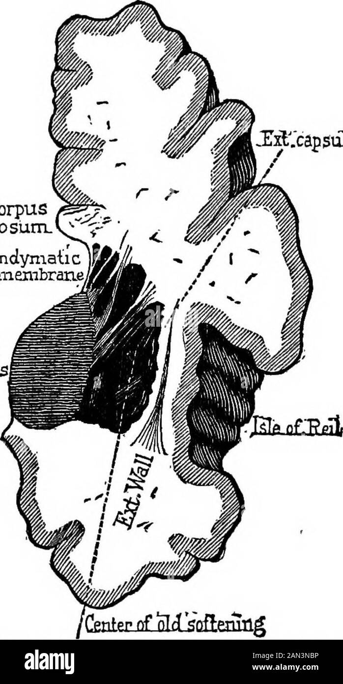 Lectures on localization in diseases of the brain, delivered at the Faculté de médecine, Paris, 1875 . na-tomical and pathologico-physiological effects of lesions occur-ring in that locality. That region, which may be called the lenticulo-striated, incontradistinction to the posterior or lenticulo-optic region,embraces, you remember, ist, the anterior two-thirds of thewhite tract called the internal capsule ; 2d, internally fromthis, the large extremity or head of the caudated ganglion ;3d, outside, by the side of the island of Reil, the anterior two-thirds nearly of the lenticulate ganglion Stock Photo