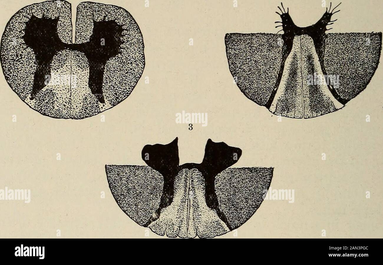 Tabes dorsalis hires stock photography and images Alamy