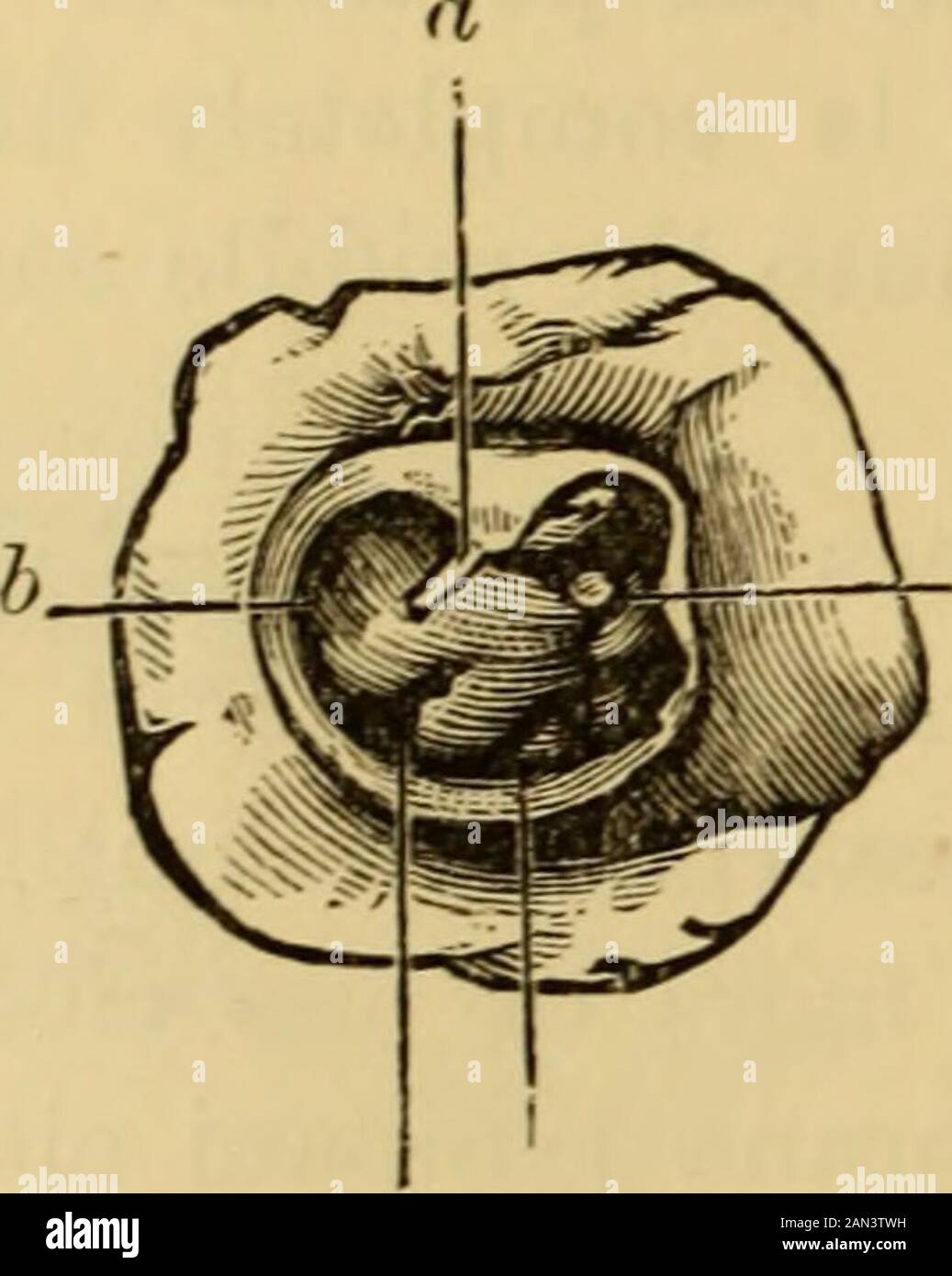 A text-book of the diseases of the ear and adjacent organs . catrix is not apparent, and when in addition the cicatricialtissue extending in front of the ost. tymp. tubas is ruptured so thatthe air can freely pass from the Eustachian tube into the external 382 CHRONIC PURULENT INFLAMMATION OF THE MIDDLE EAR. meatus. This causes the non-adherent portions to remain im-movable when air enters the tympanic cavity. In larger defects ofthe membrane often only some portion of the posterior (Fig. 212),lower or anterior remnant of the membrane is fastened to the innerwall of the tympanic cavity by mean Stock Photo