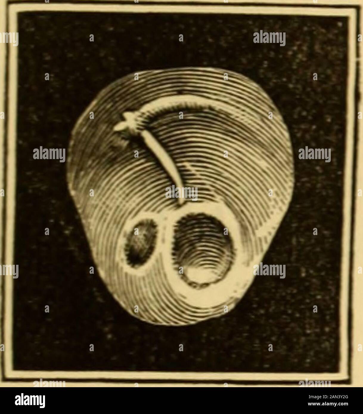 A text-book of the diseases of the ear and adjacent organs . dherent, lay inside of this. The detachment of the handle of the malleus can only be diagnosed in theliving if the upper part of the handle is in its proper position, while the navelof the membrane is very much flattened, and shows excessive movement with ADHERENT CICATRICES ON THE MEMBBANA TYMPANI. 379 Siegles speculum. That by detachment of the handle of the malleus thetransmission of sound from the membrane to the ossicula is much diminished,is self-evident. 2. Adherent Cicatrices ; Adhesion between the Membrana Tympaniand the Inn Stock Photo