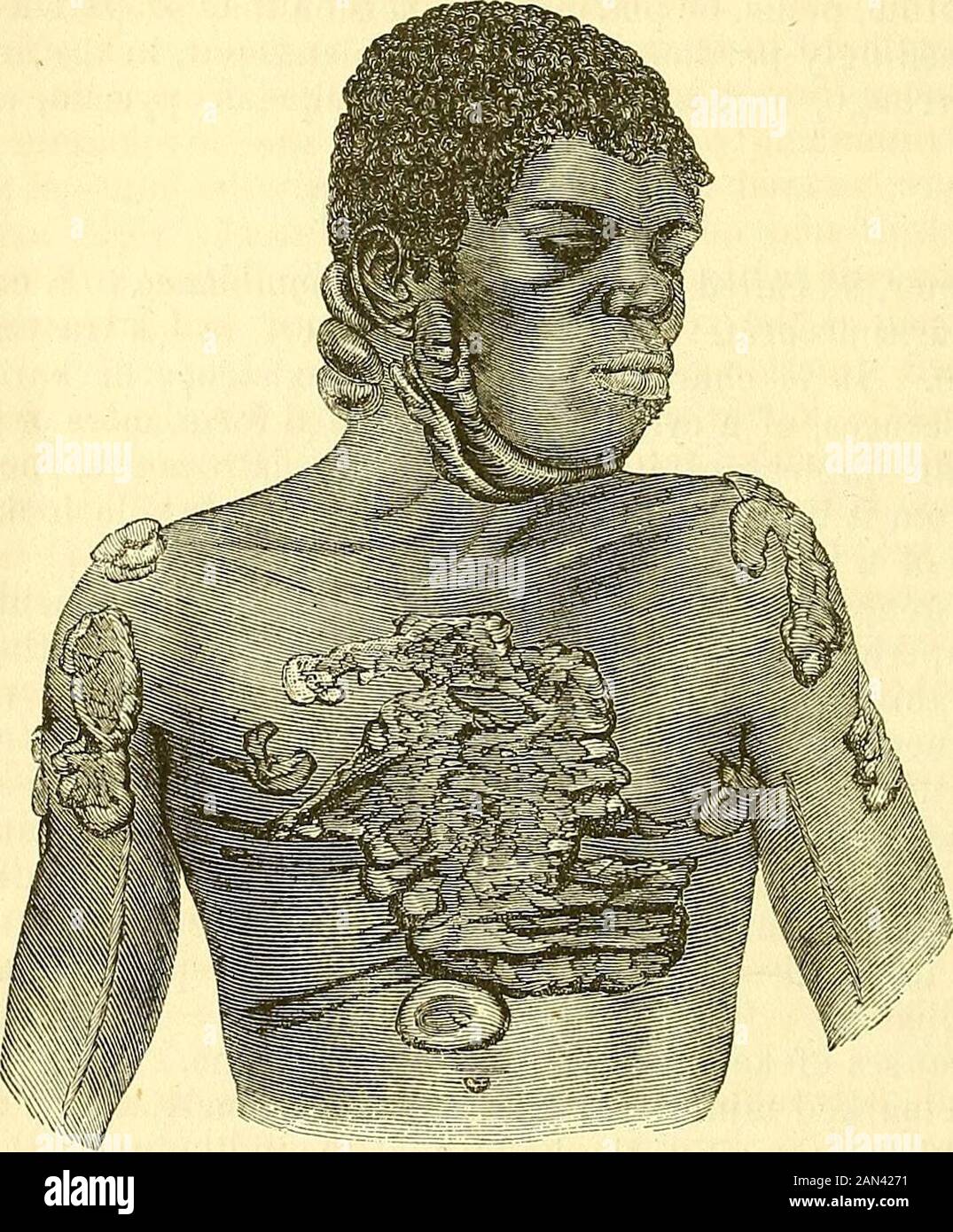 A system of surgery : pathological, diagnostic, therapeutic, and operative . ^ observation, an immense number of these excrescences appeared spon-taneously upon different parts of the body within a few months after the firstmanifestation of the morbid action. The peculiar external characters of keloid will readily be understood from theannexed drawing, fig. 194, taken from a colored man upwards of fifty years of Fig. 194.. Keloid tumors. age, whose body was literally covered with morbid growths of this kind. Theywere particularly numerous on the neck and trunk, both in front and behind, andals Stock Photo