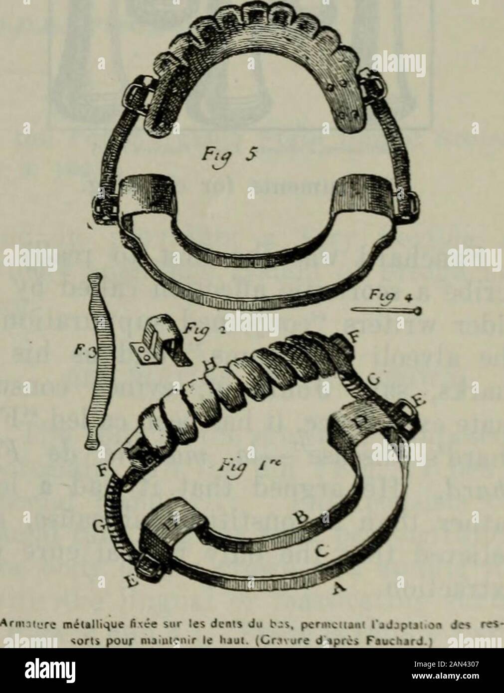 The Dental cosmos . Fig. 7, dcnner 1 ressou pernietiaui la presence do* dcn;s WfVifnri du bavFig. i, 3. ;, 4. les Oiierentji pieces qui c&lt;xnposeni le denuer ,Gra*urcdapriH Fauchard ) Denture with springs; full upper and par-tial lower. Fig. U.. Metallic fixture adjusted on lower teeth toradaptation of springs to hold upper den-ture in place. 1244 THE DENTAL COSMOS. of his predecessors. As he seems to havebeen the first to construct such formid-able apparatus, the ingenuity which hedisplayed in their contrivance entitleshim to much credit. Dr. John H. Meyerof New York, in the Cosmos for Sep- Stock Photo